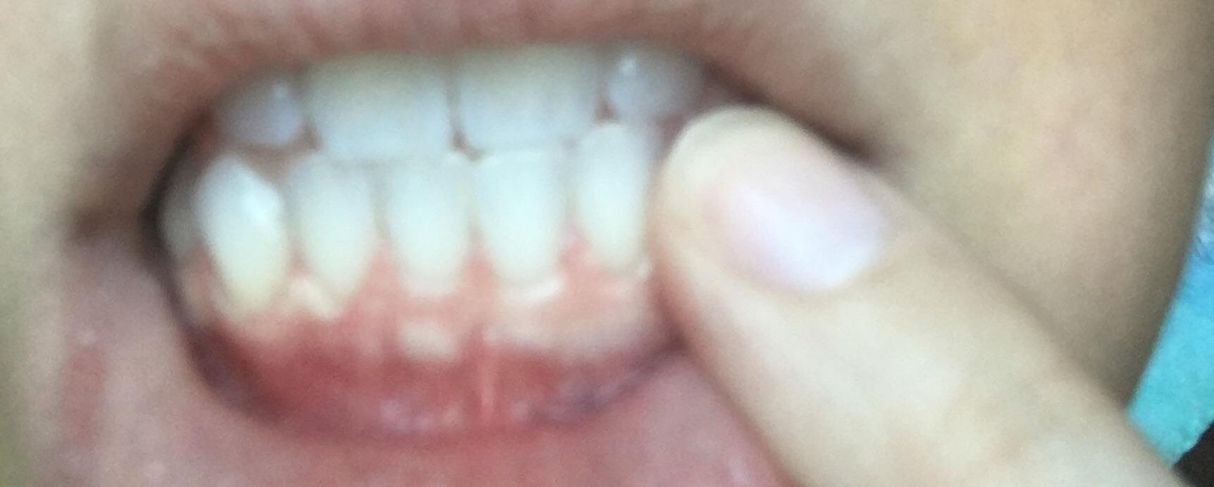Does Hydrogen Peroxide Whiten Teeth Reddit TeethWalls