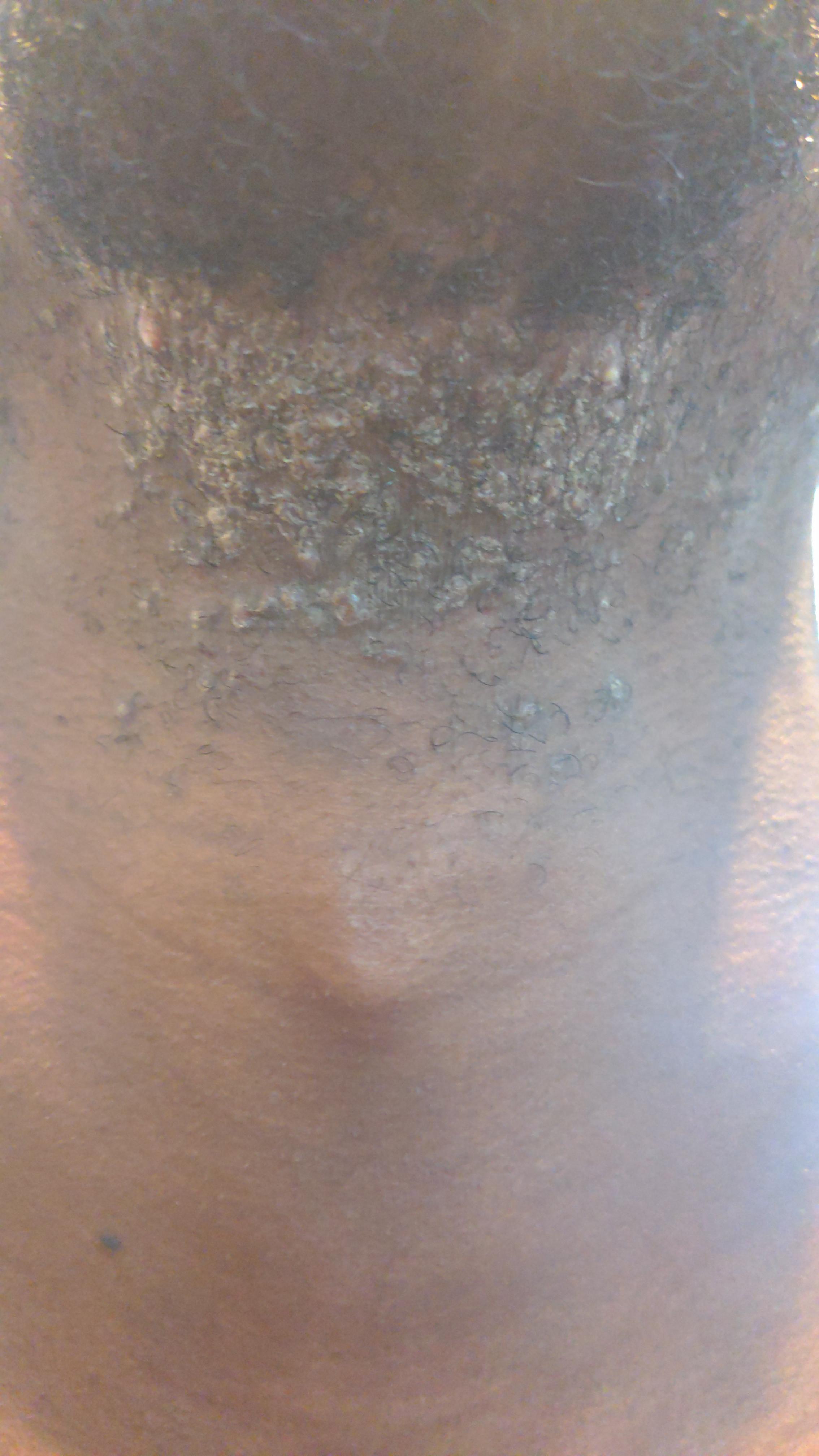 This always happens after I shave. Eventually the hair grows back and