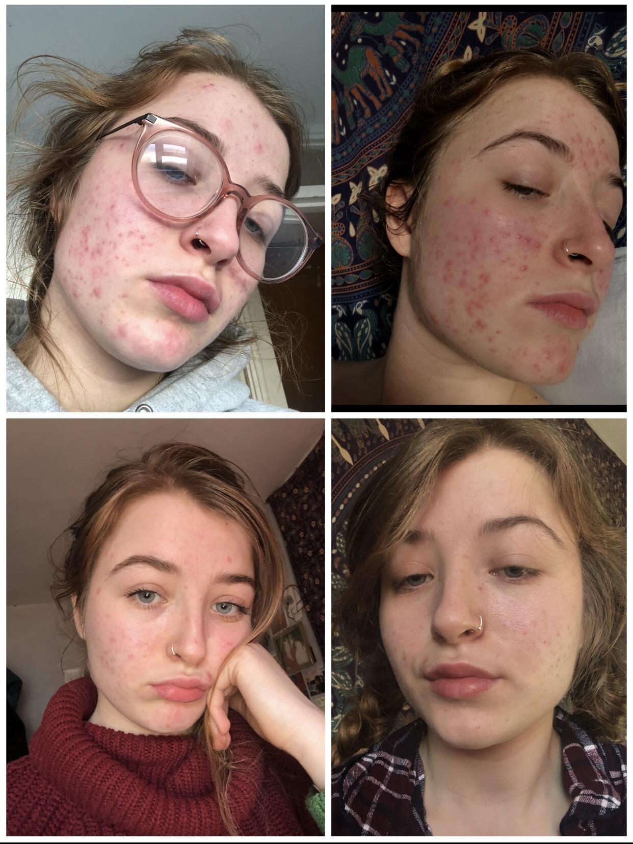 Acne progress! (1 and 2 are when I started antibiotics (Lymecycline), 3 was when I just finished