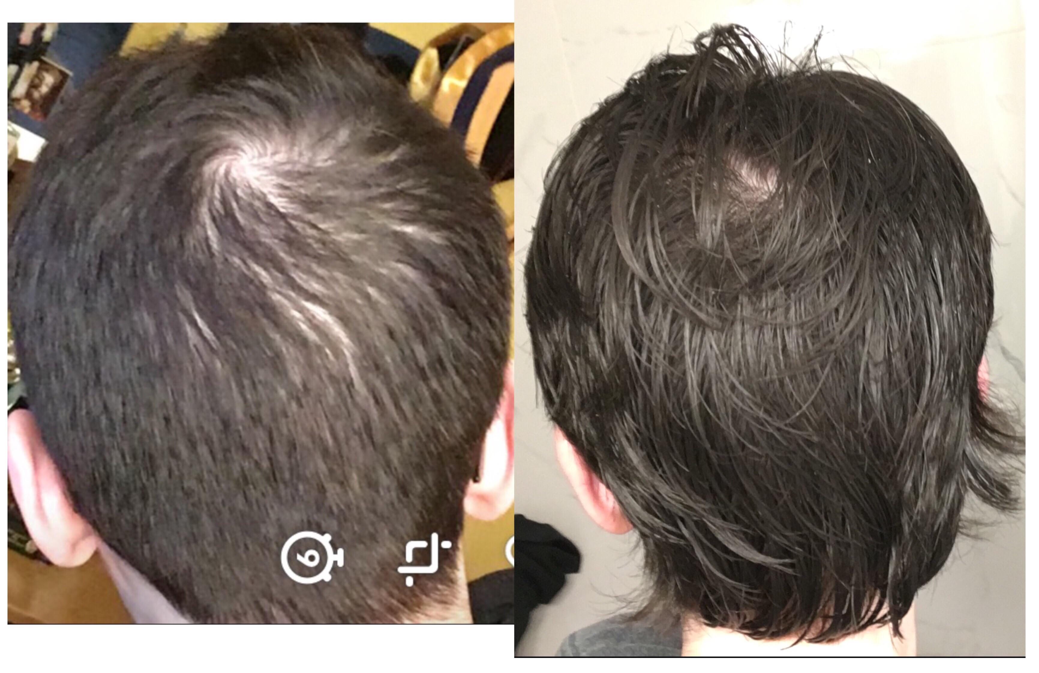 Should I go on rogaine? My crown looks really bad with short hair but