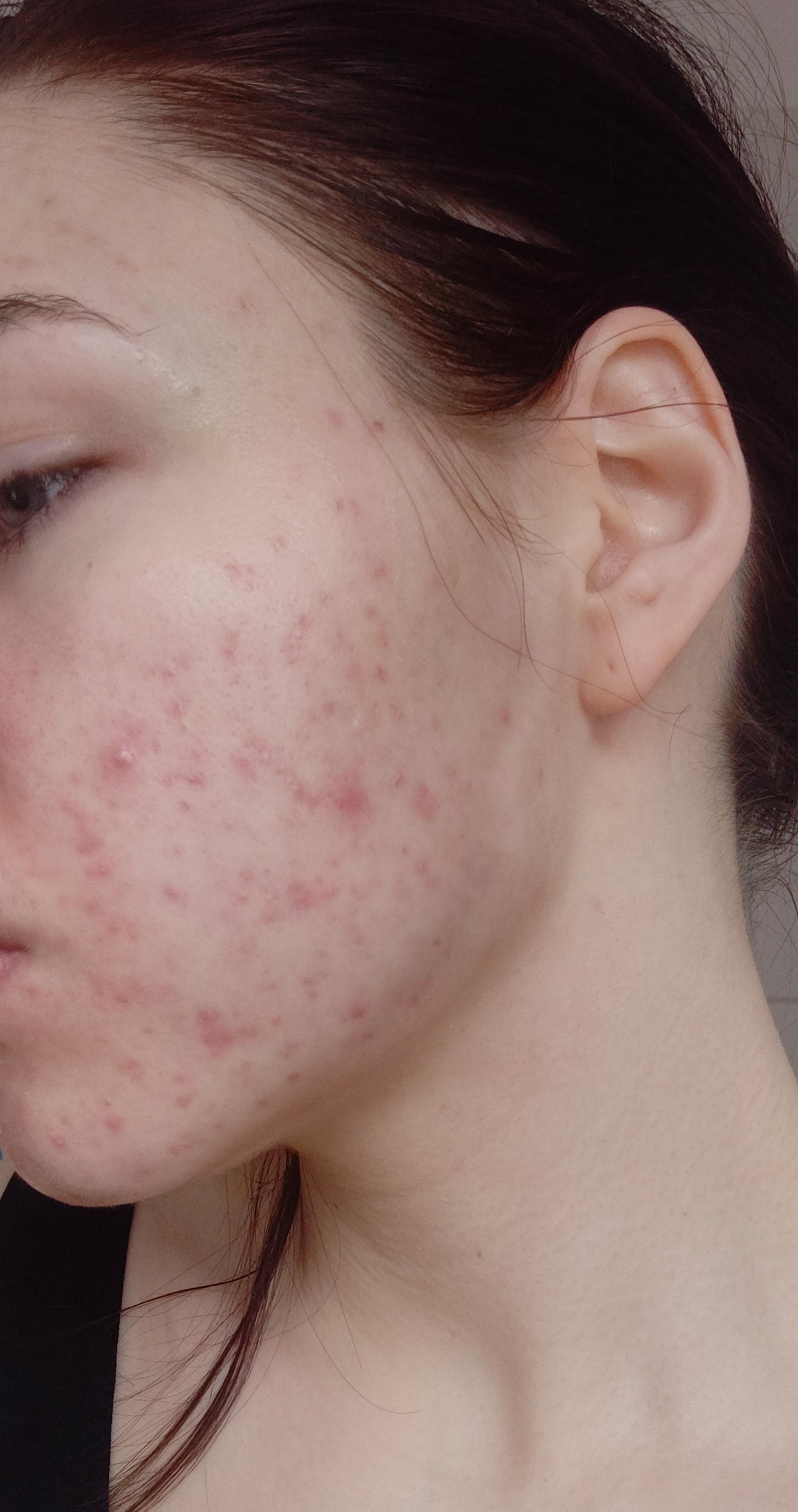 [skin concerns] I'm 20 and still struggling with acne on my cheeks. I