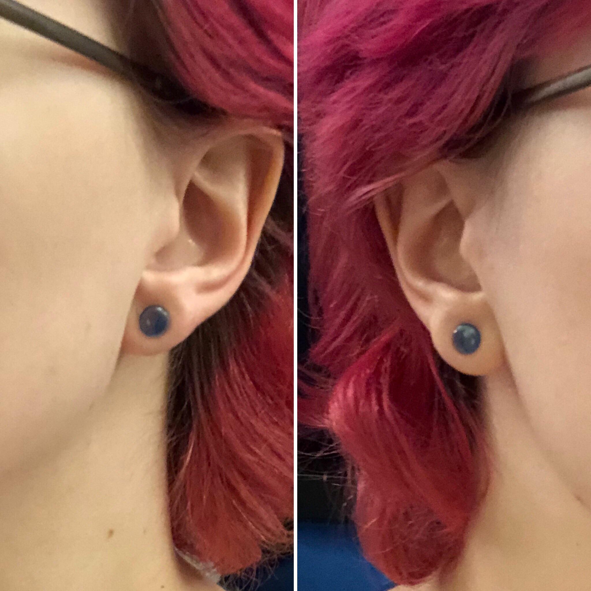 Do my ears look too uneven/thin to continue stretching? Currently 5mm