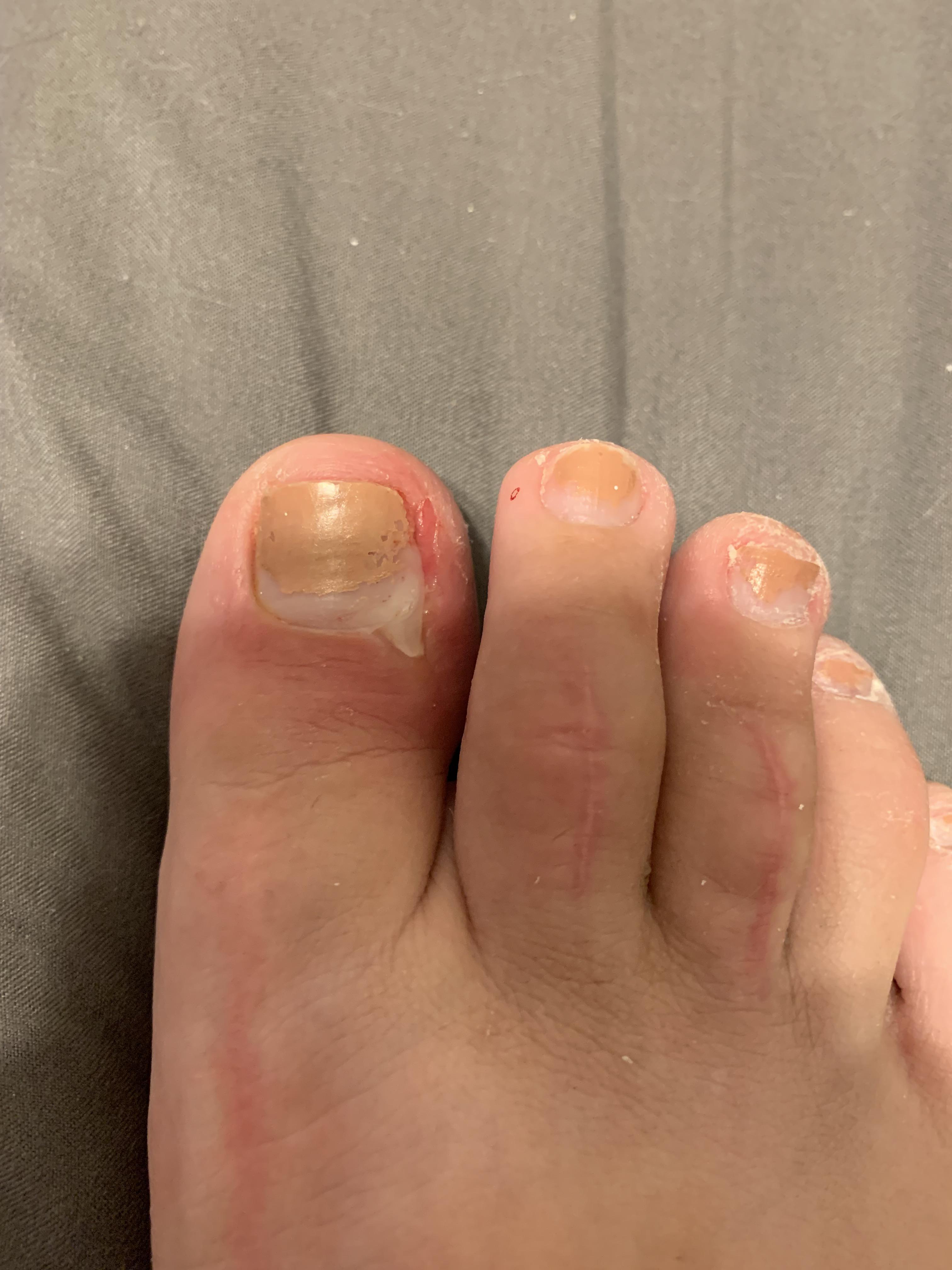Ingrown toenail I performed surgery on myself popping