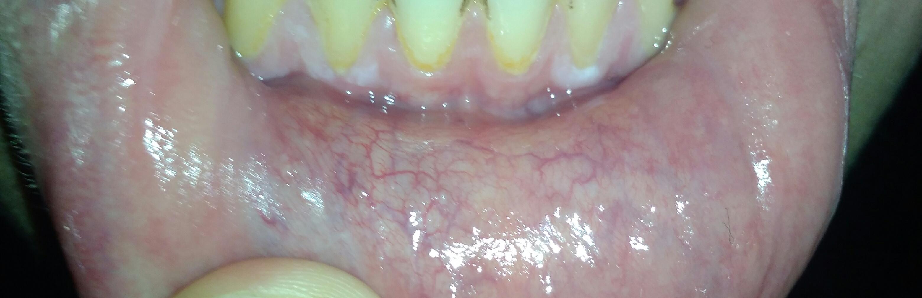 White Spots On Gums