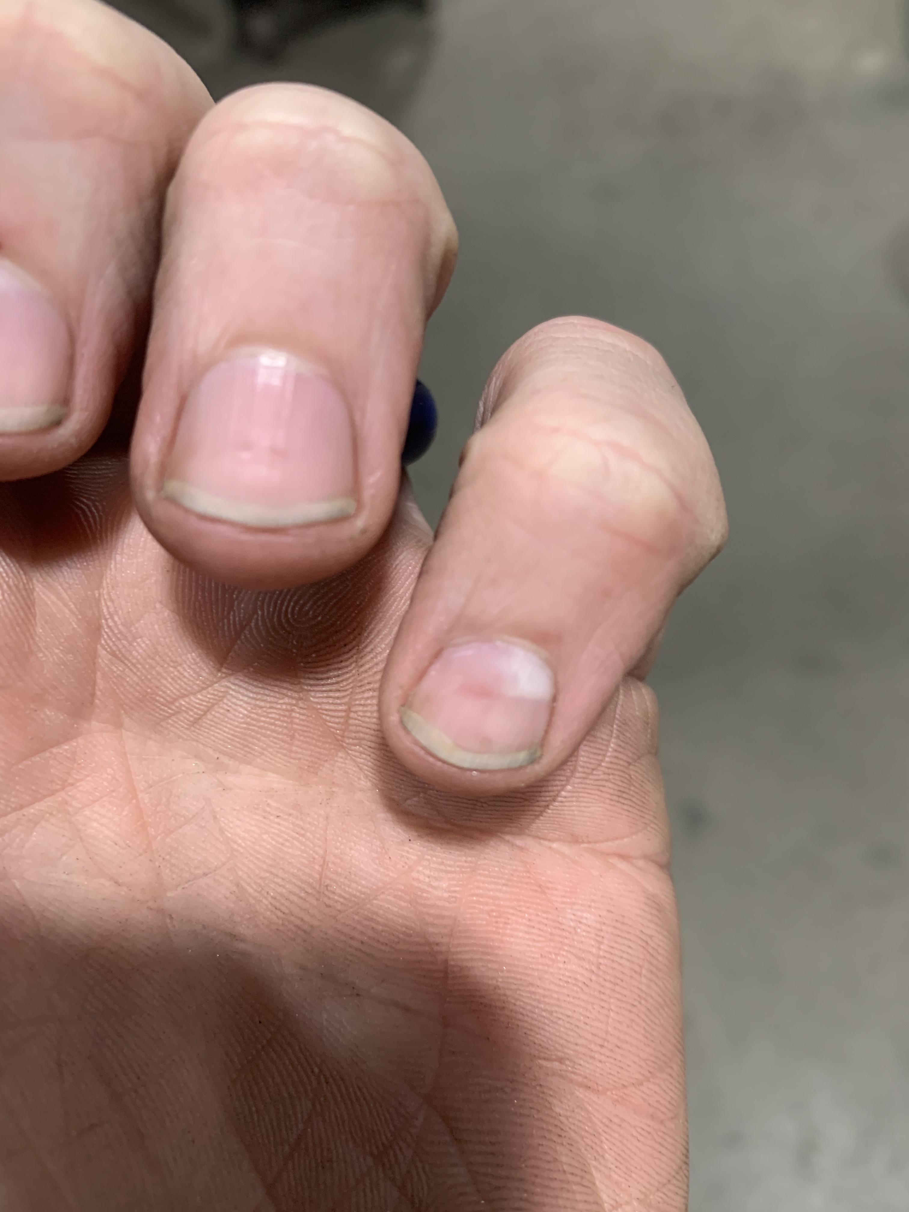 Just noticed my pinky nail is getting pale. All google does is essentially tell me I have cancer
