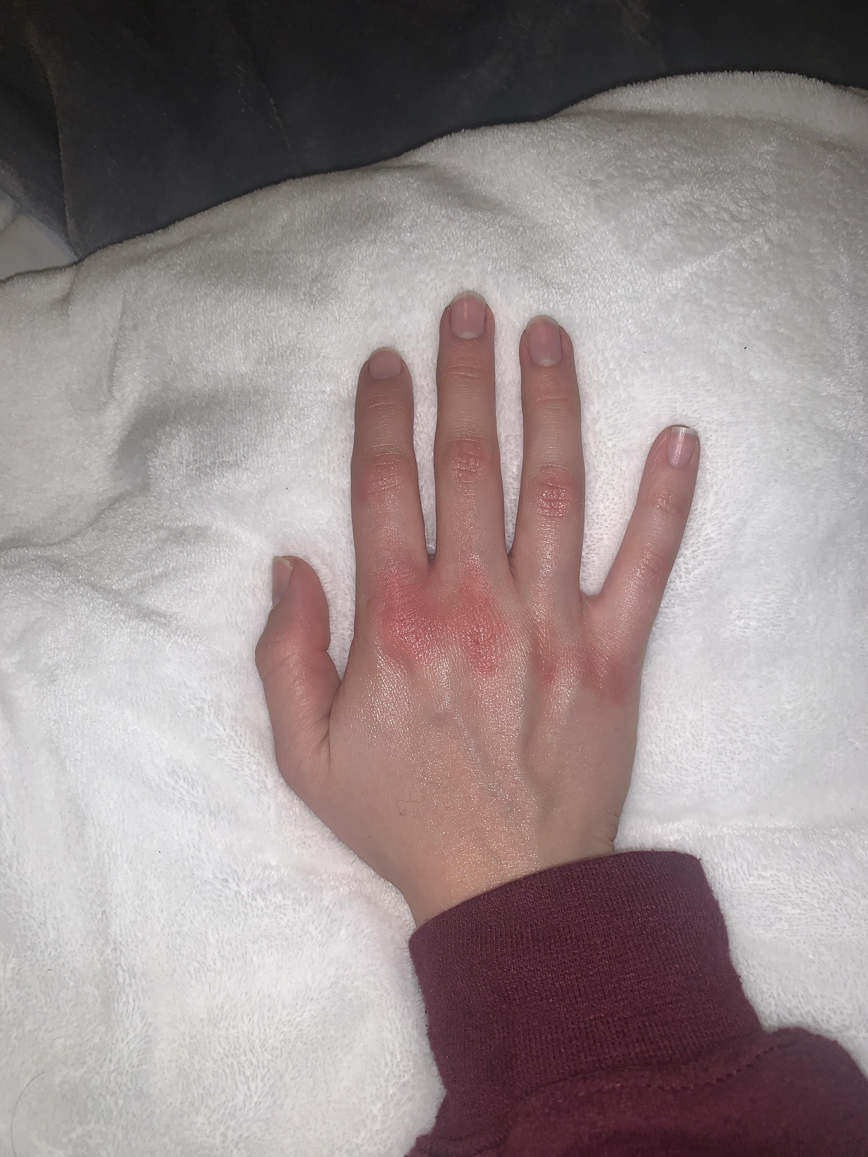 weird knuckle rash. what is it? can anyone help? thanks! r/Dermatology