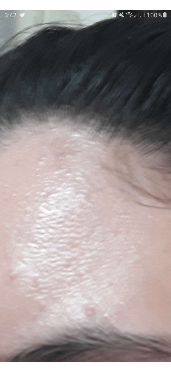 Help. How do i get rid of this on my forehead. Its somewhat scaly idk. Ive tried moisturizing it