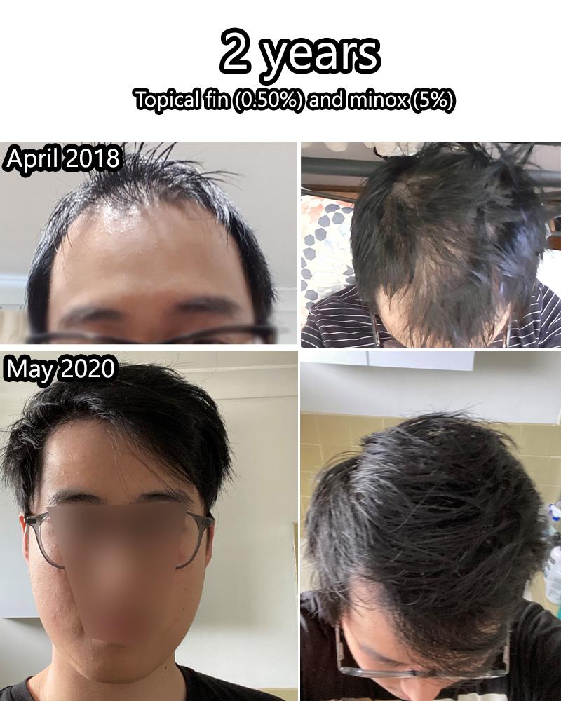Finasteride Before and After Pictures & Reddit Stories