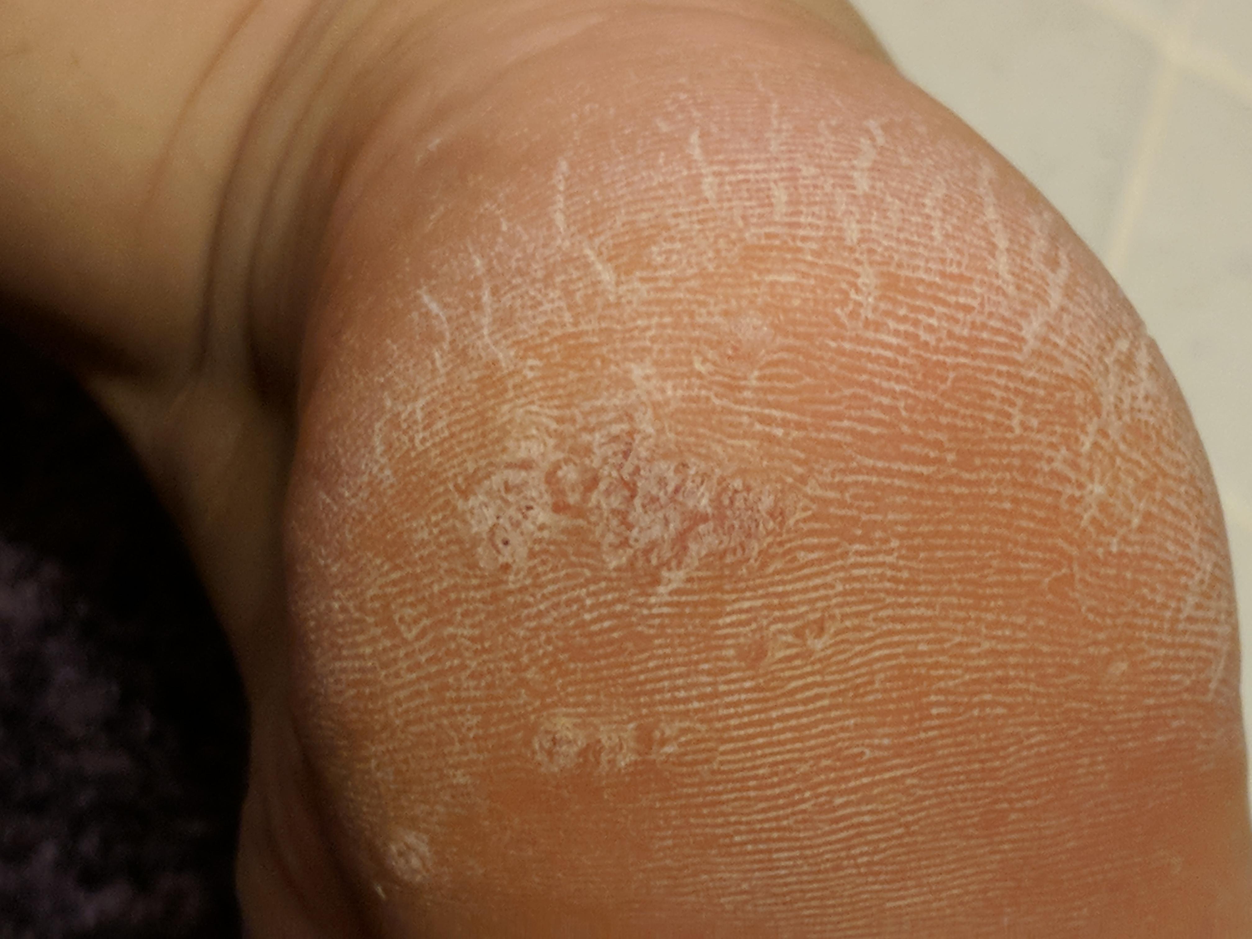 What's causing this on my foot? Skin blistered away, a few spots with