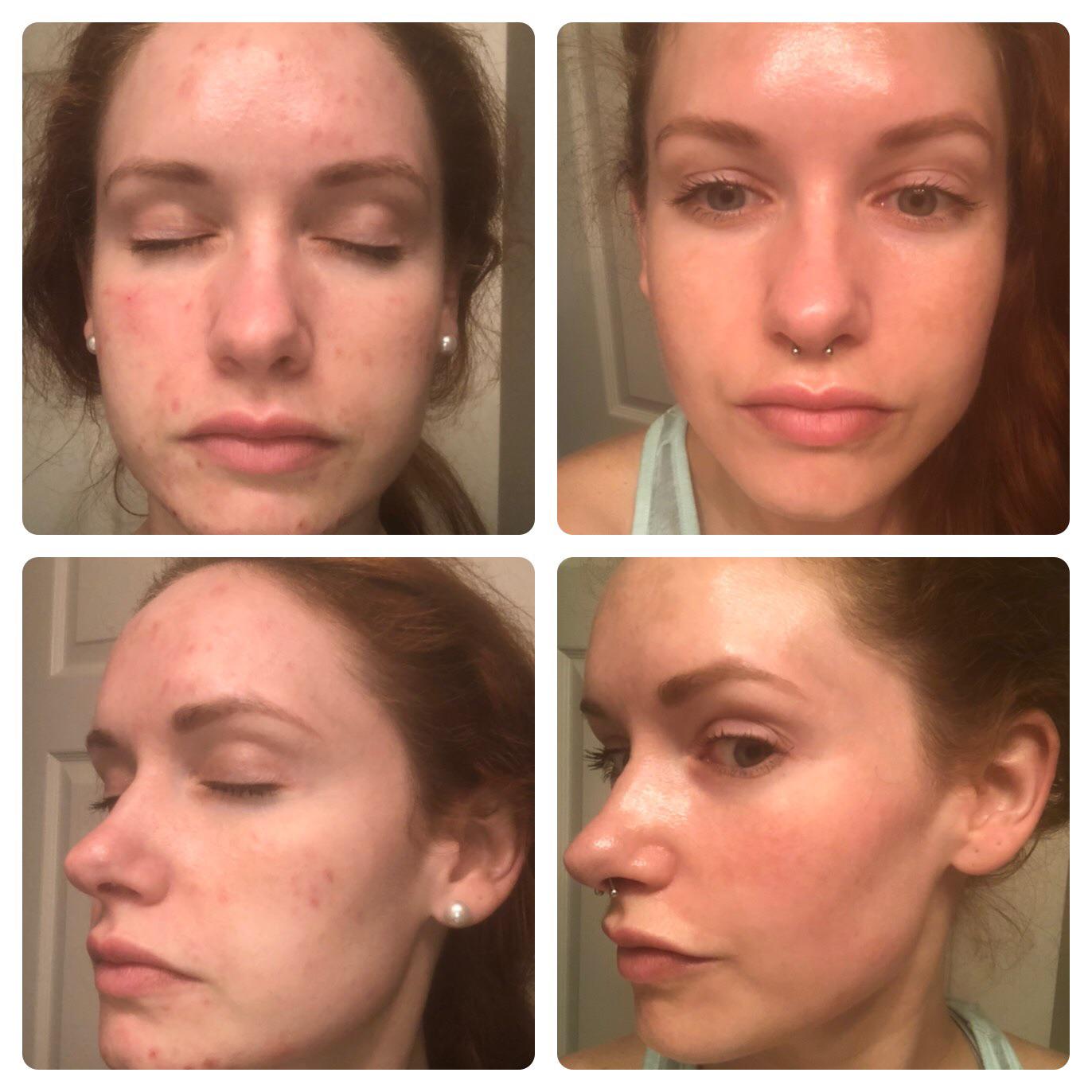 3 months on 50 mg spiro, 7.5 Dapsone, and 0.025 tret, routine in