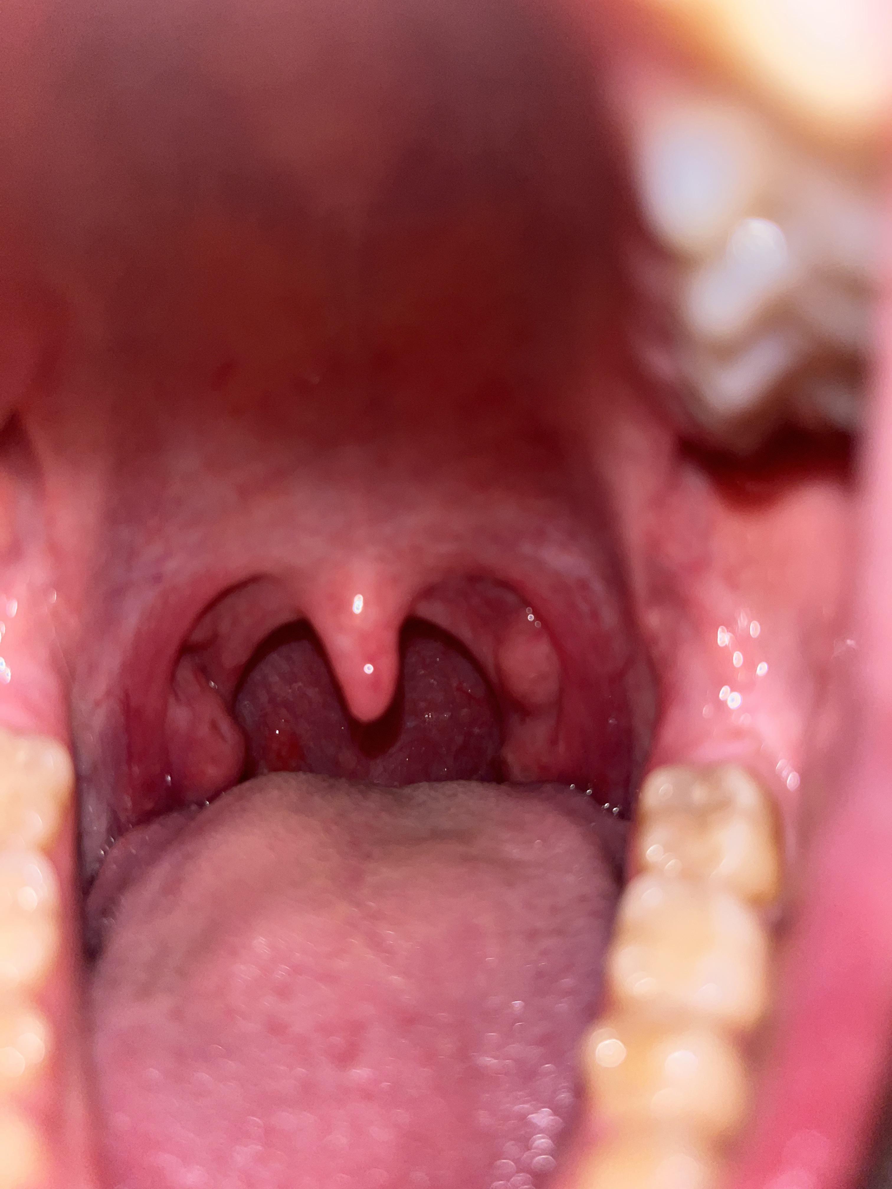 I started getting tonsil stones for the first time after having covid