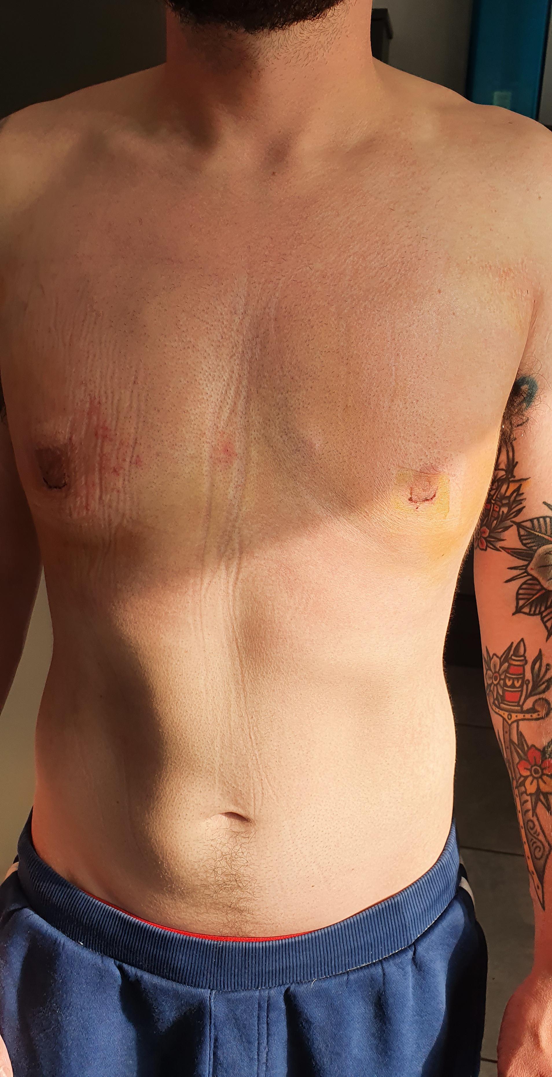 2 weeks after gyno surgery. Looks great and flat until I flex my chest