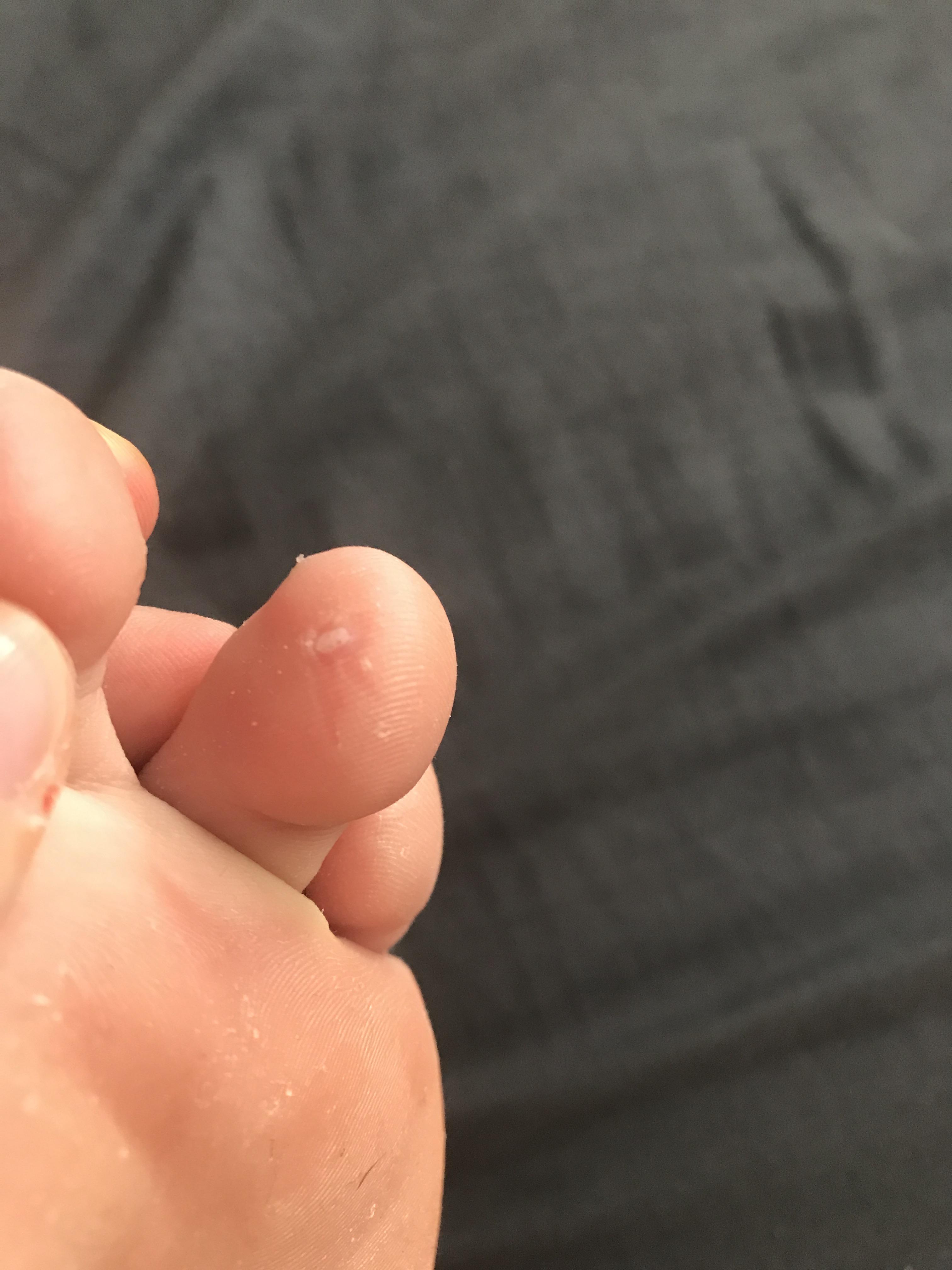 what is this? I thought there was a callus on my toe, so I clipped it