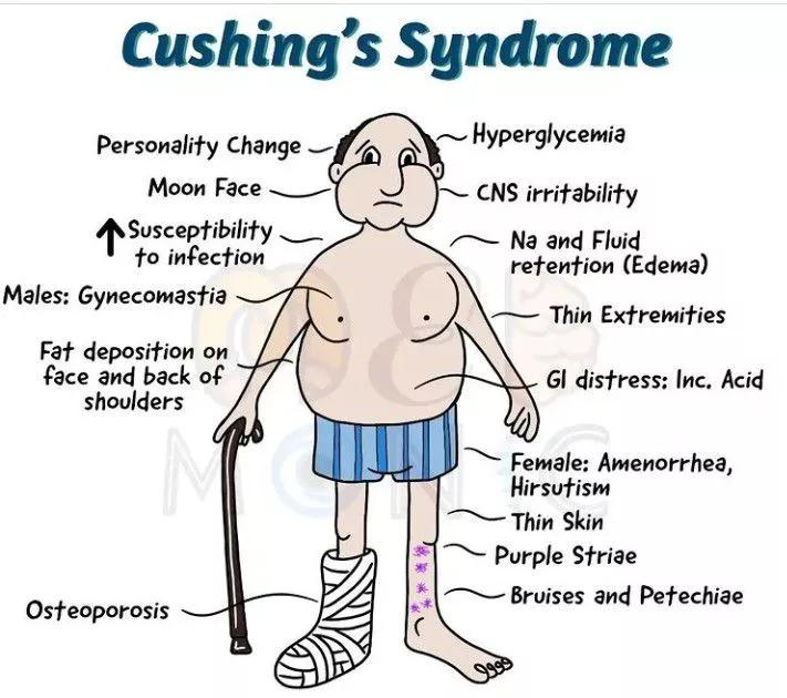Cushing Syndrome r/MedExams