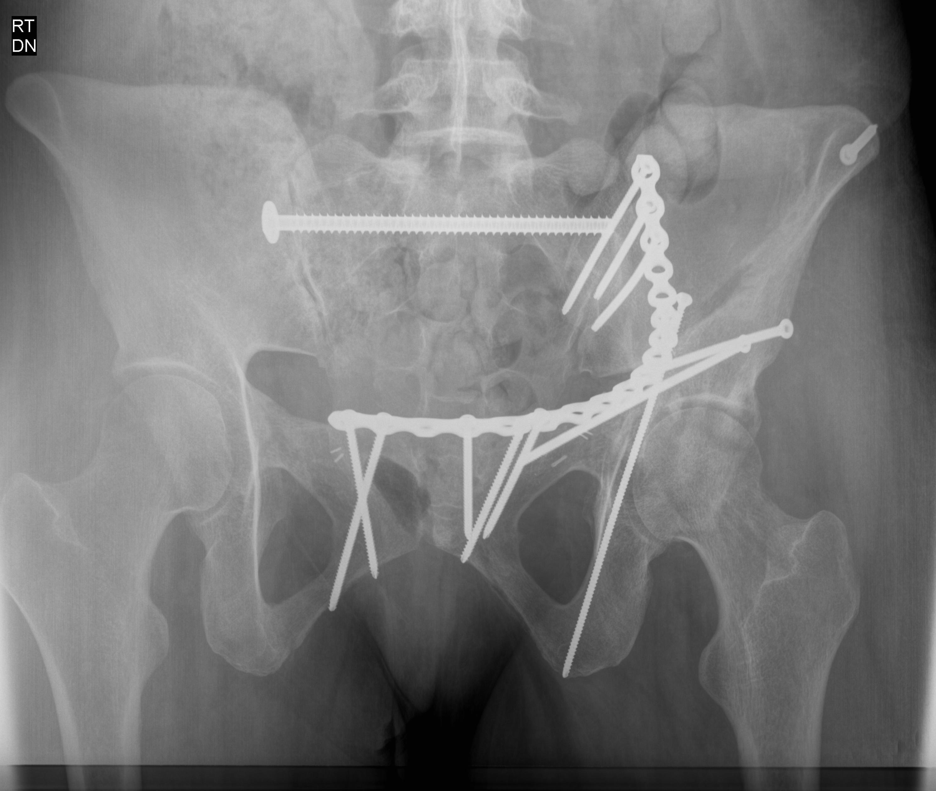My pelvis fracture after bad car accident and surgery. r/Radiology