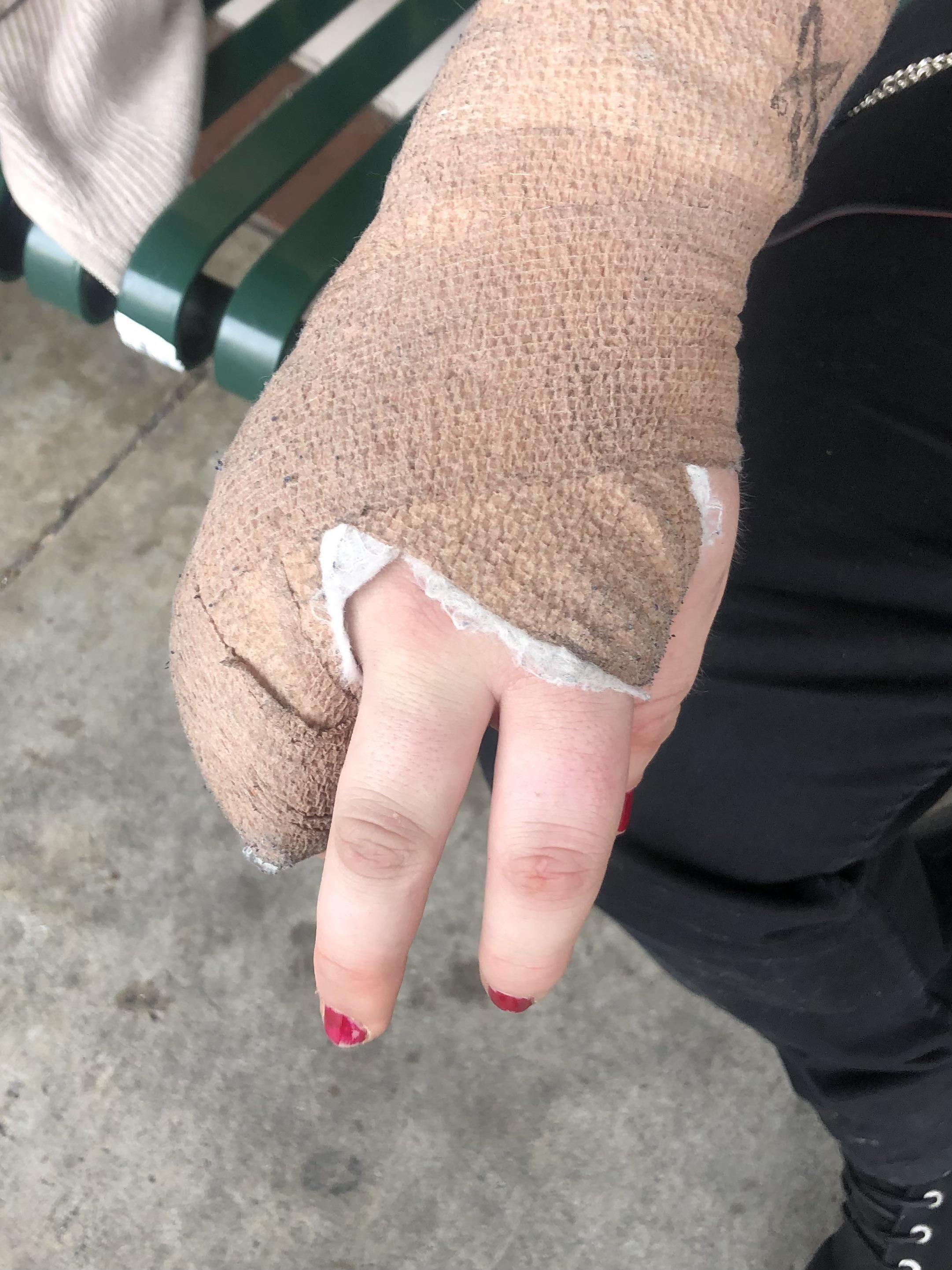 Broken Knuckles From Punching