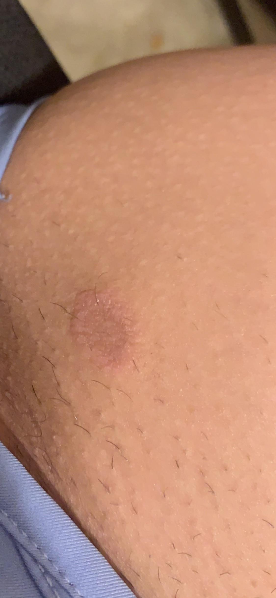 One doctor said this is nummular eczema, another thinks it