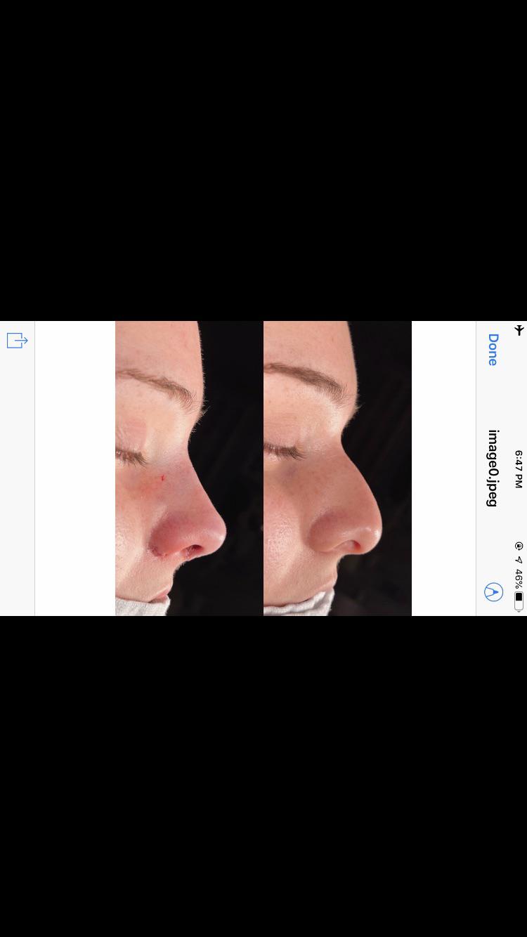 Rhinoplasty results Dr. Asaria in Toronto r/PlasticSurgery