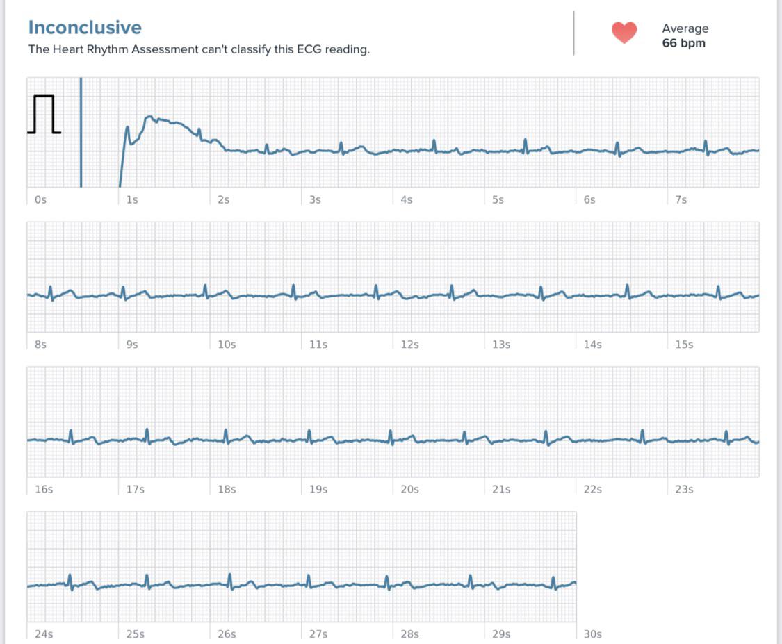 Does this look normal? r/PVCs