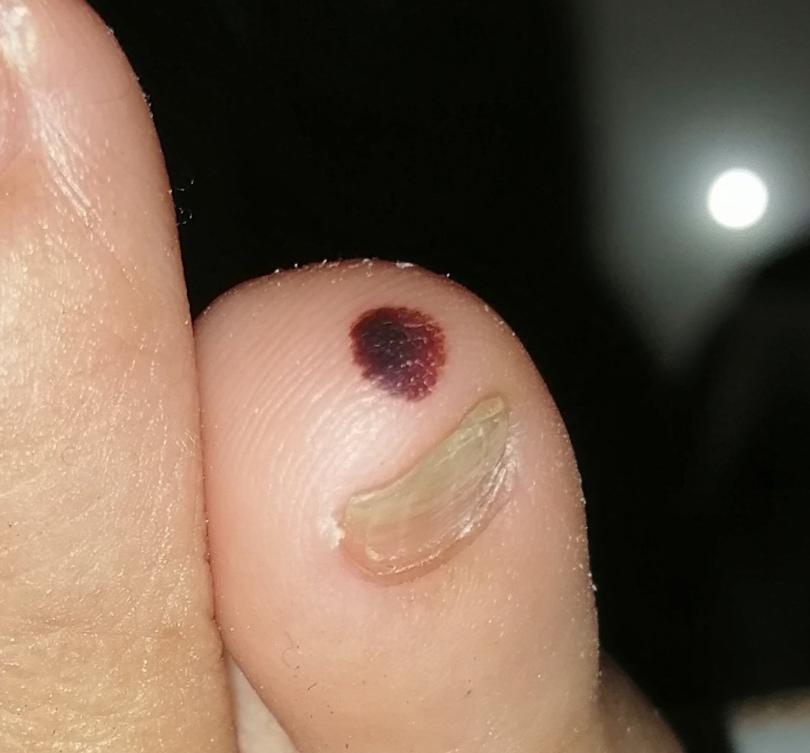 What does this look like to you? Flat mole on my toe appeared a couple