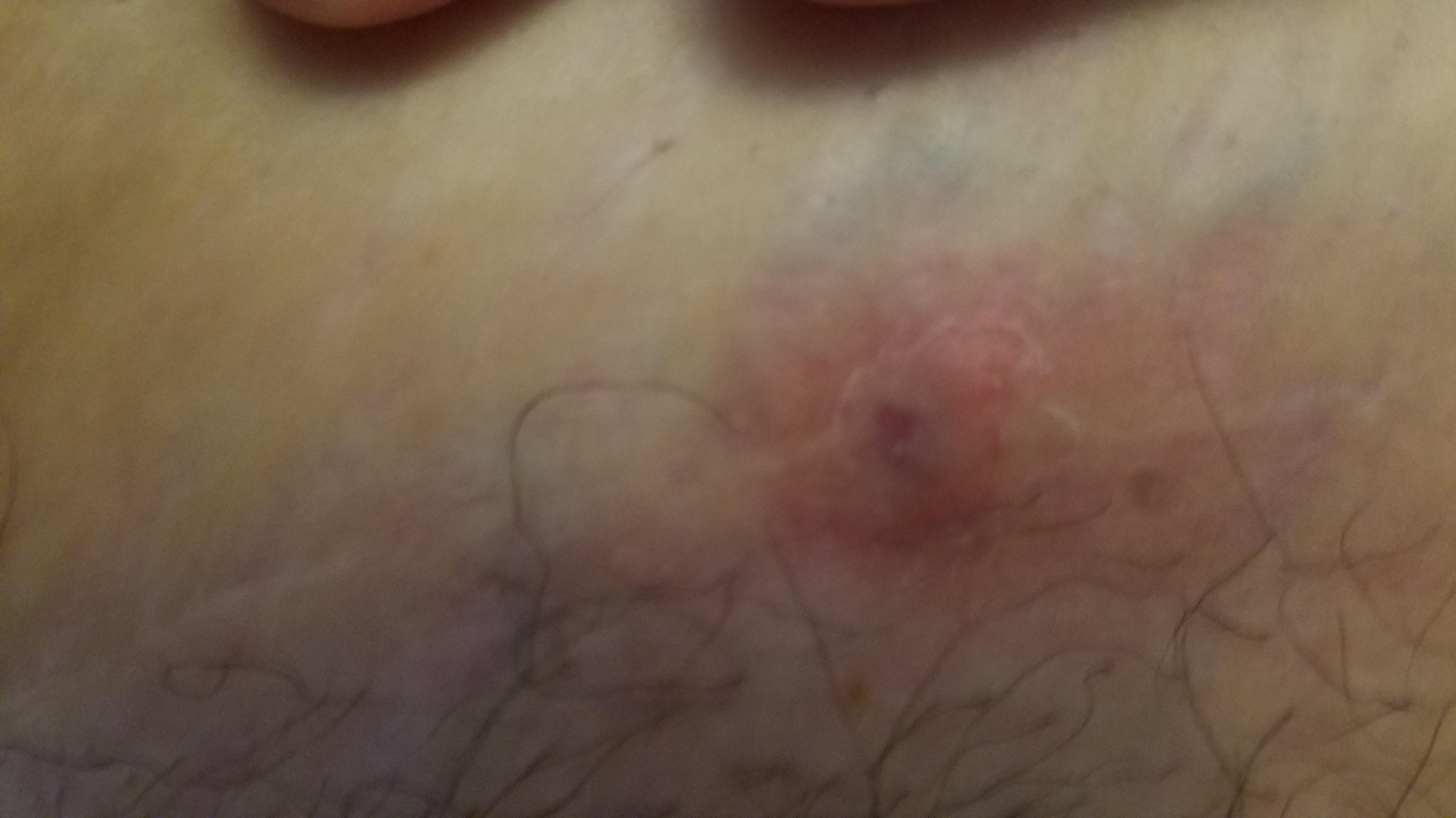 I have noticed a hard lump for a while but today I see its looking