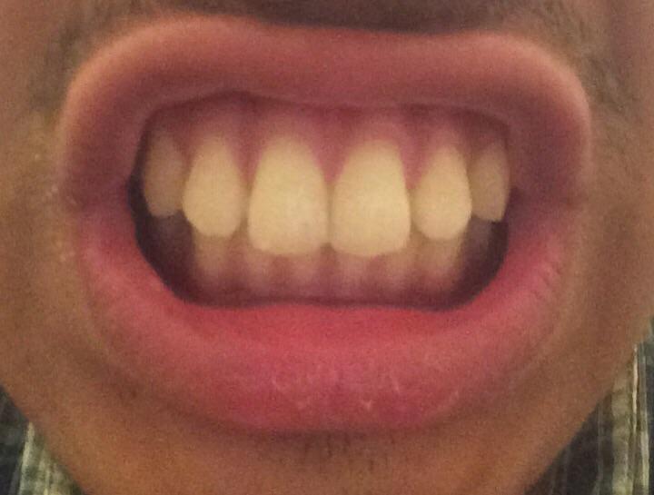 How To Know If You Need Braces Reddit / Does Insurance Cover Braces