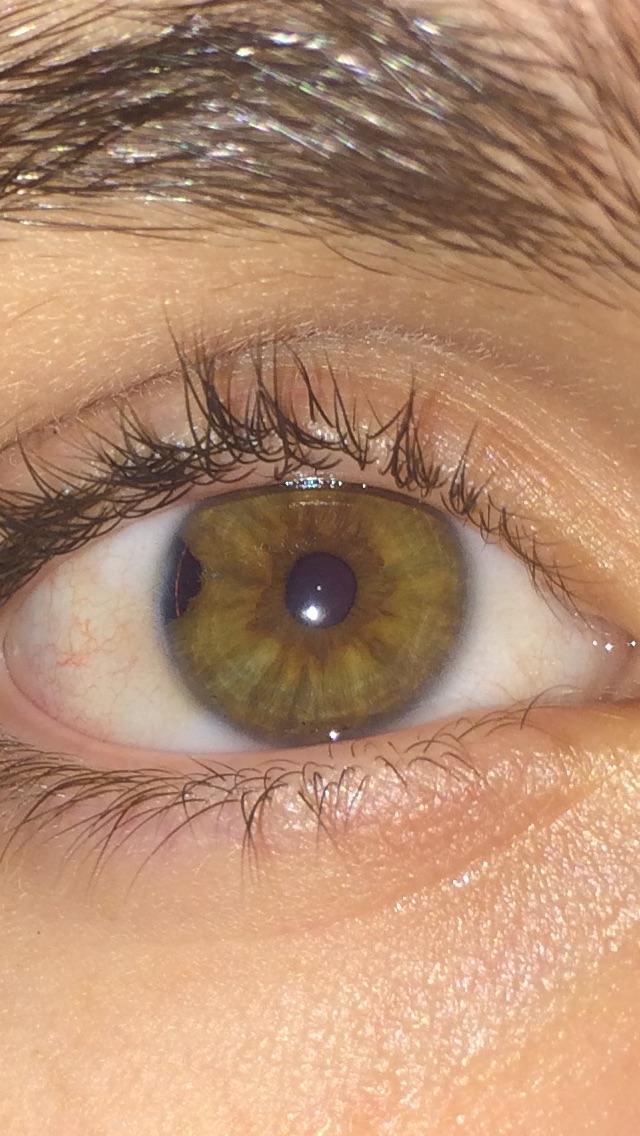 Impact hole from when I was shot in the eye with an airsoft gun r