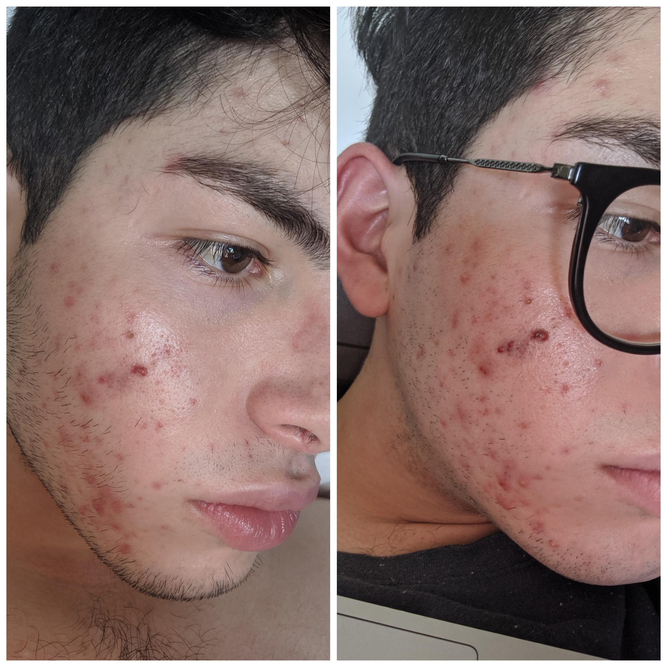 [Routine Help] Is it normal for Epiduo to cause irritation/burning