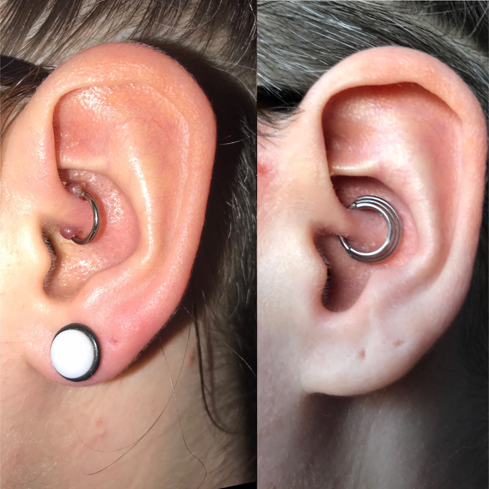 Hypertrophic Scar Recovery (Daith); a quick PSA to say that the road