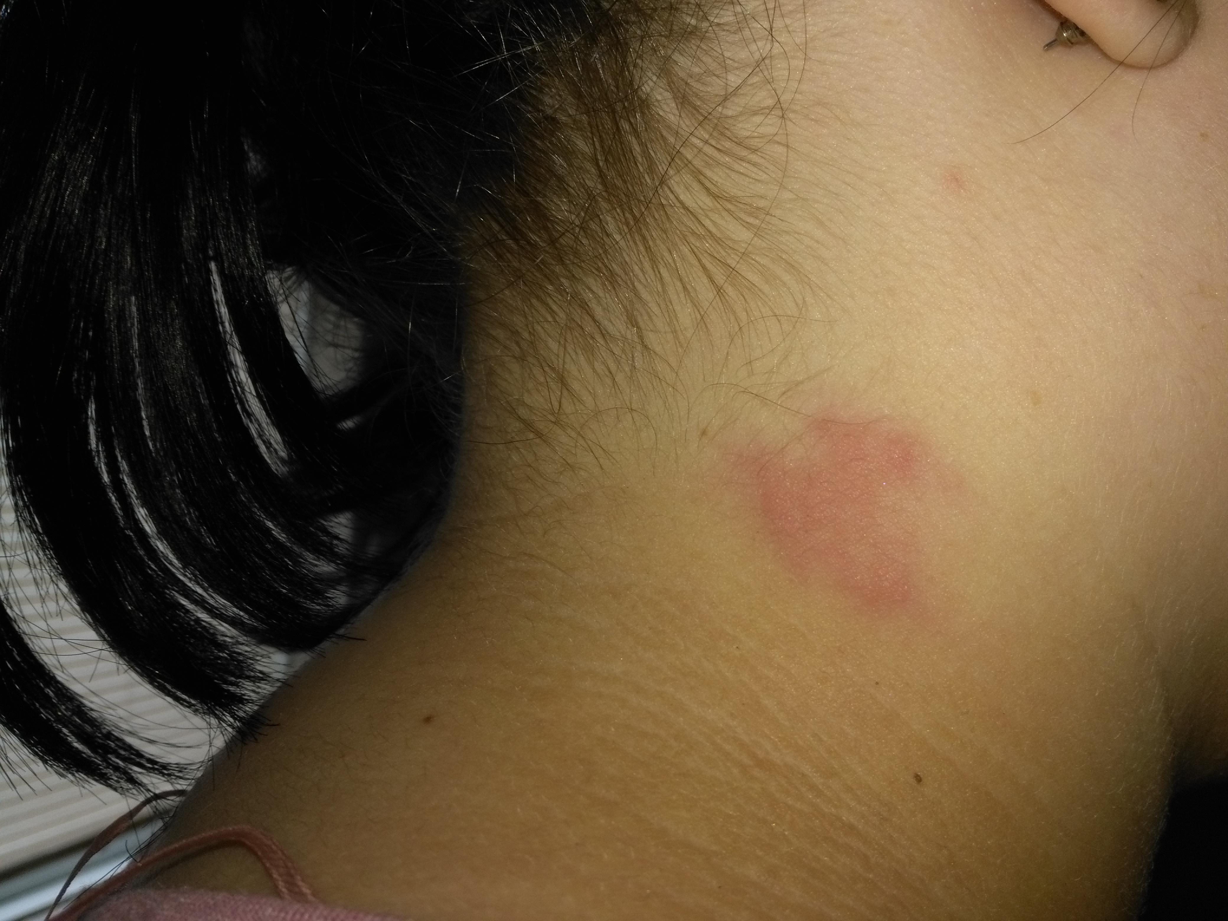 Red rash like patch on neck. Not itchy, but painful to