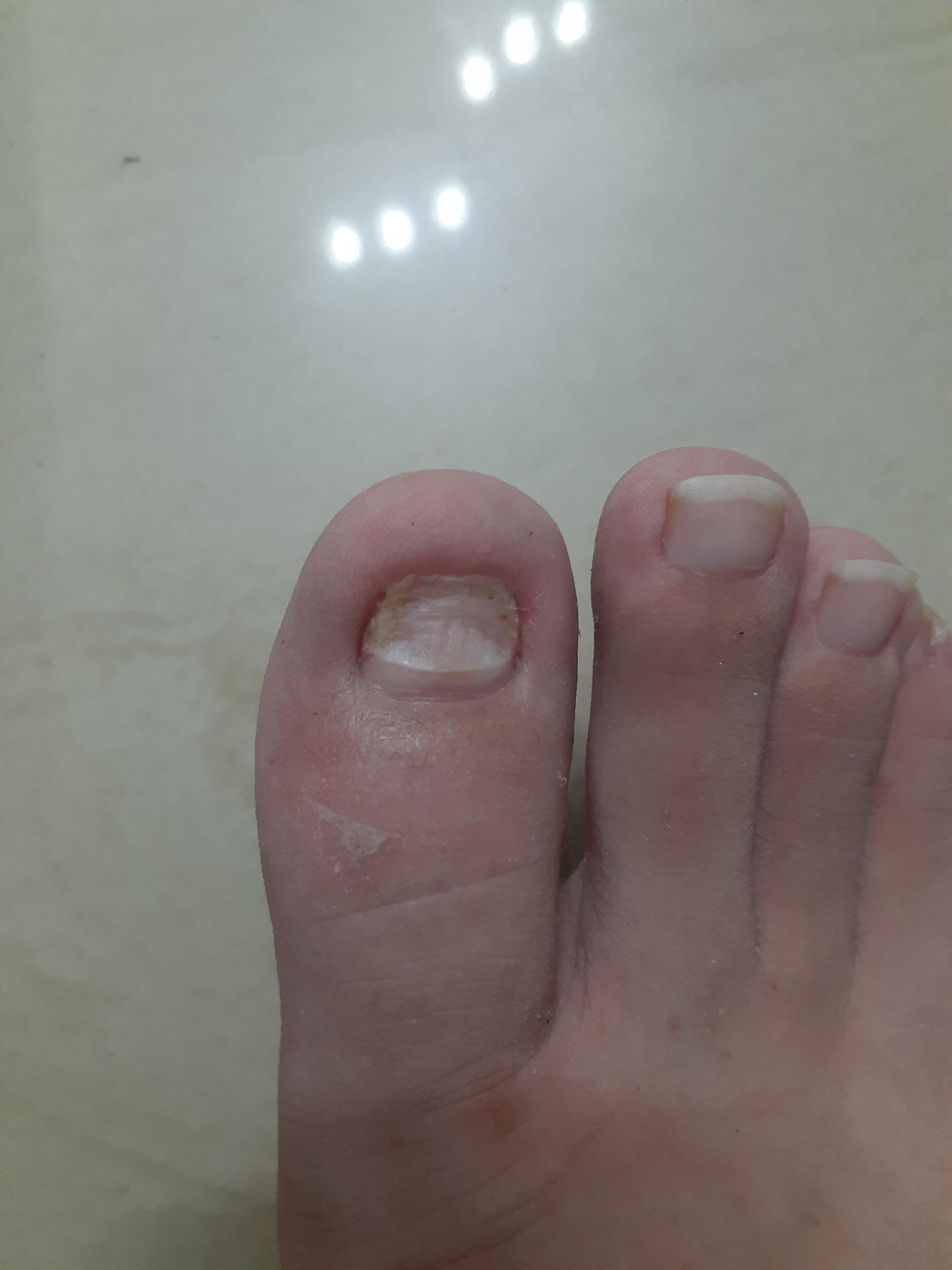Hi guys may i ask is my toenail going to grow out properly on the left
