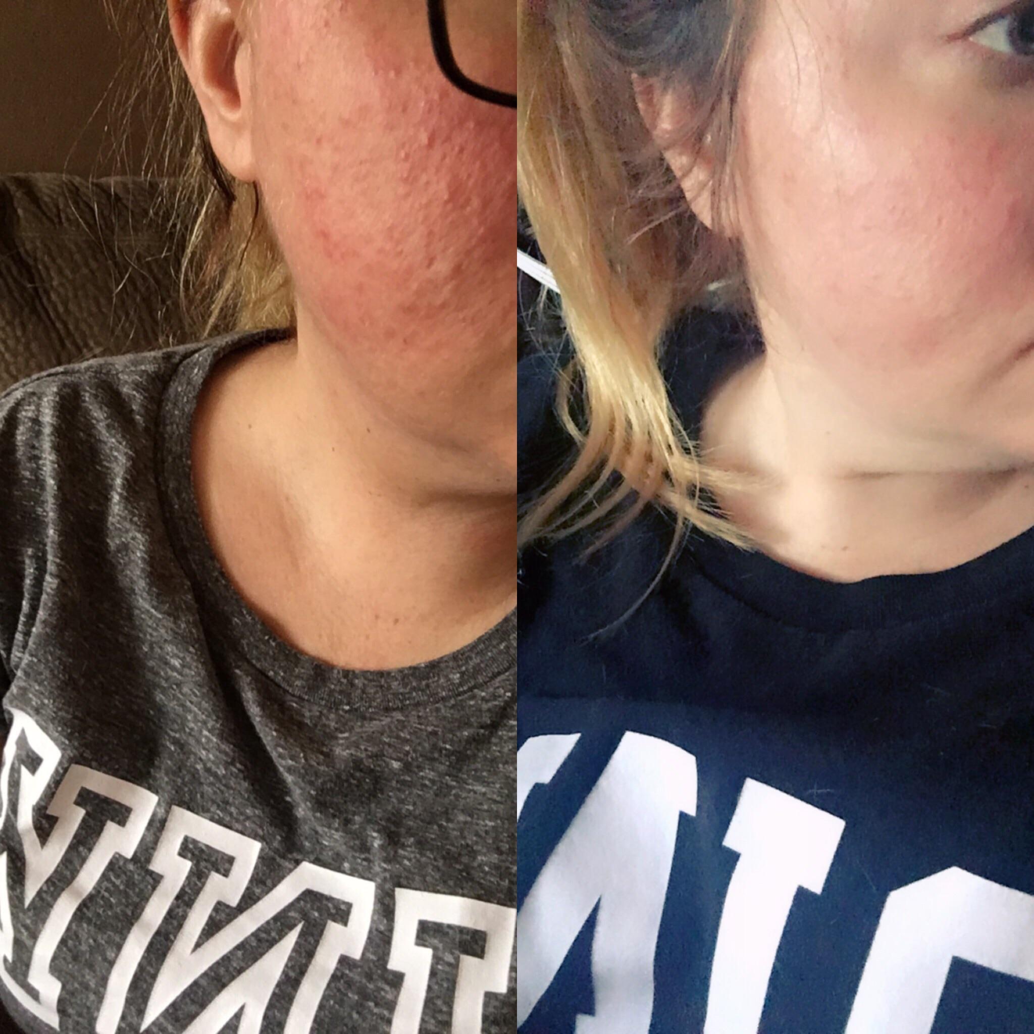 Nothing better than the steroid acne rash when you’re done with your