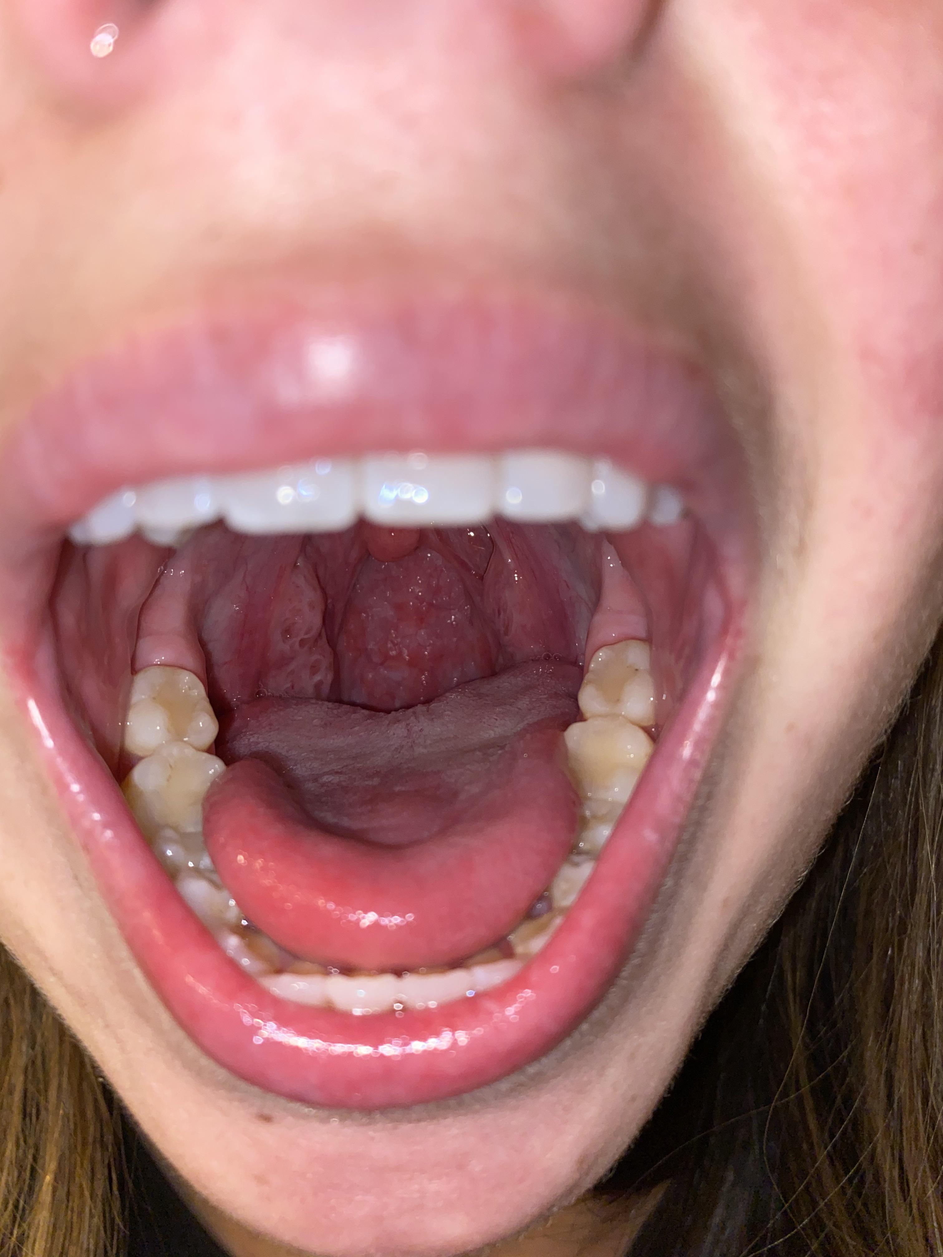 Do these circles have tonsil stones in them? I definitely have noticed bad breath not going away