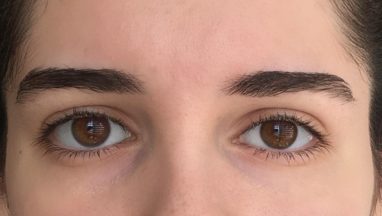 i want to correct my eye asymmetry. Do i have hooded eyes or just