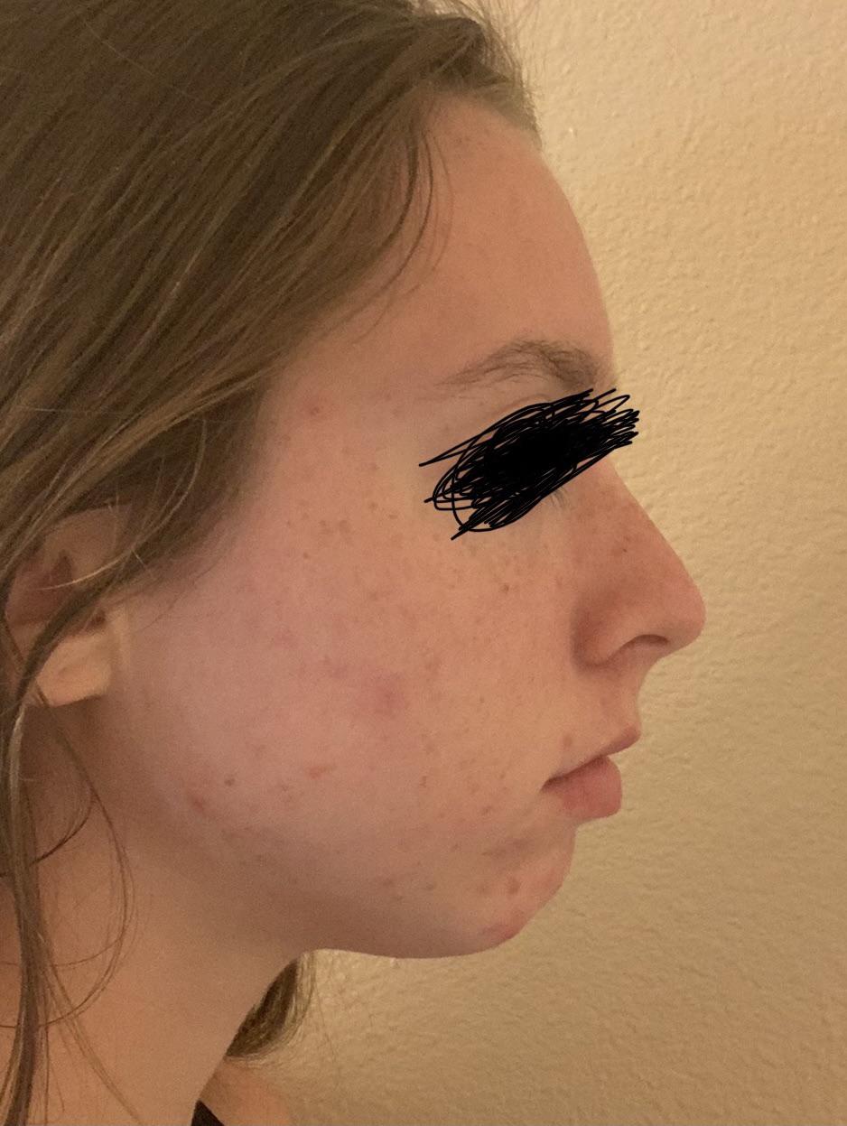 Sliding genioplasty, double jaw surgery, or both? (18F) r/jawsurgery