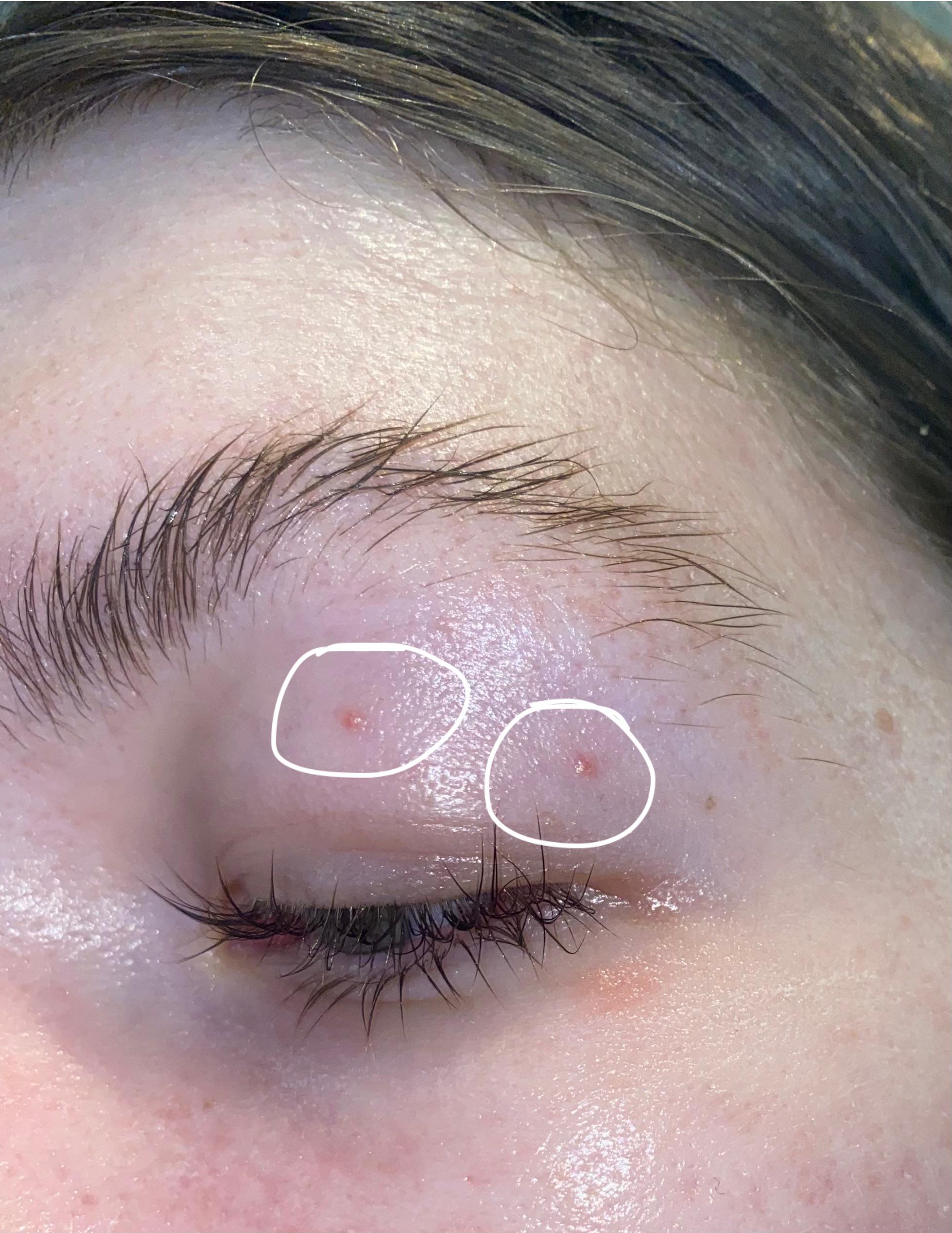 Had 2 milia on my upper eyelid for 2 months. Started using retinol eye