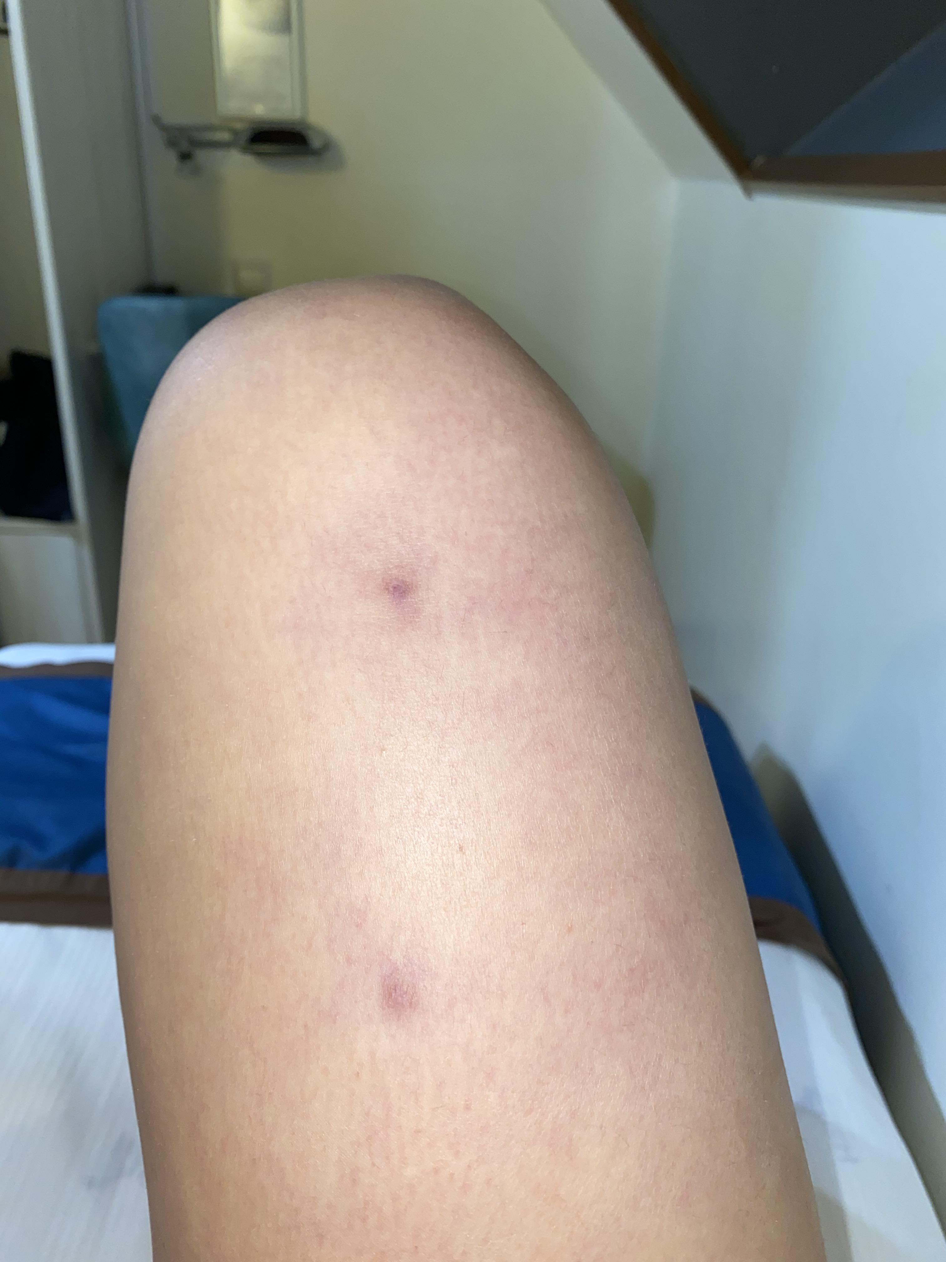 List Of Ingrown Hair Scar Removal 2022
