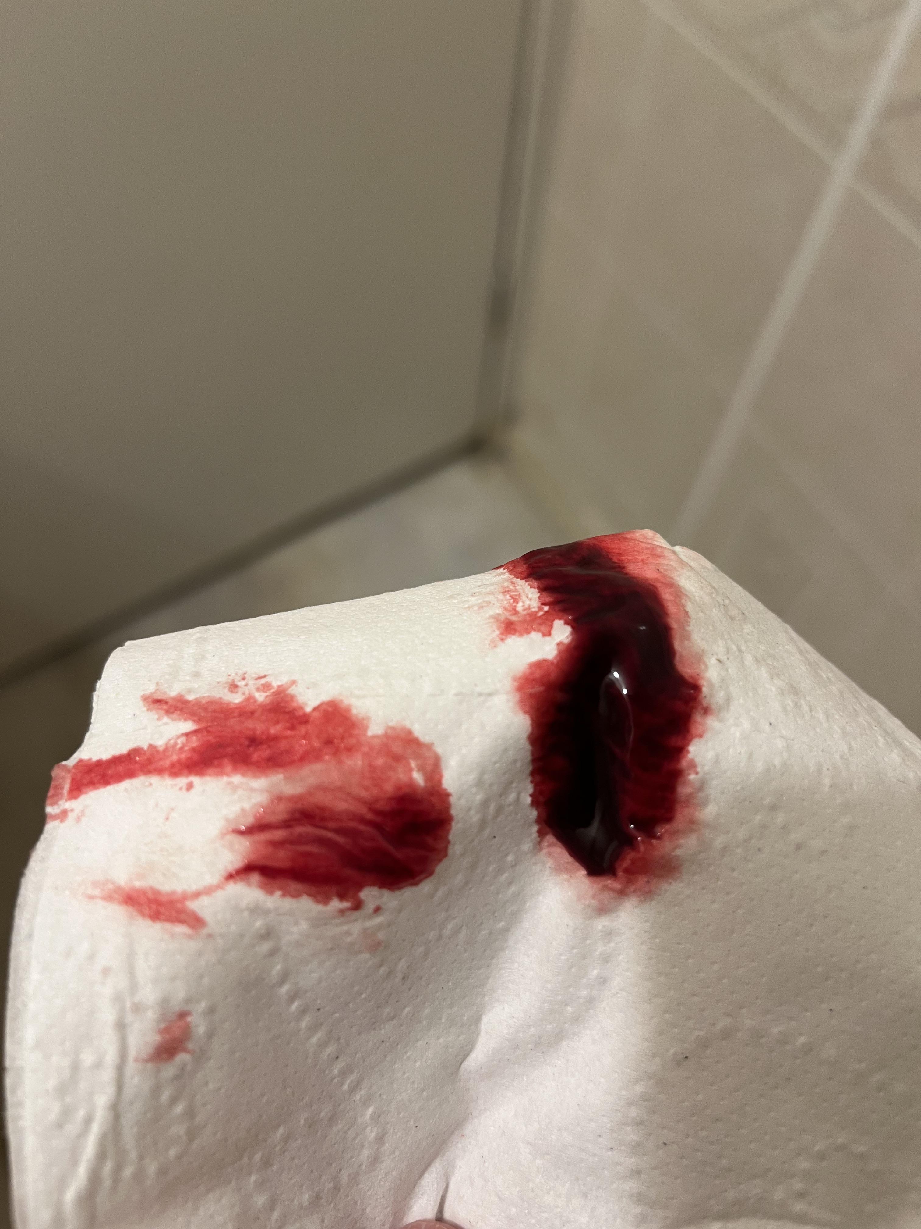 How to tell the difference between implantation bleeding and a period