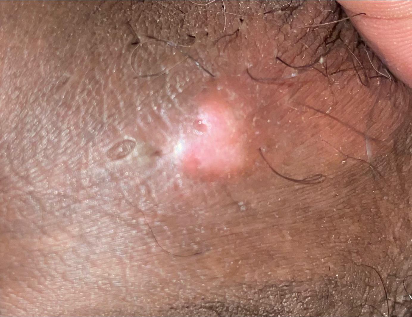 Need help identifying bump on penile shaft and if it’s benign r
