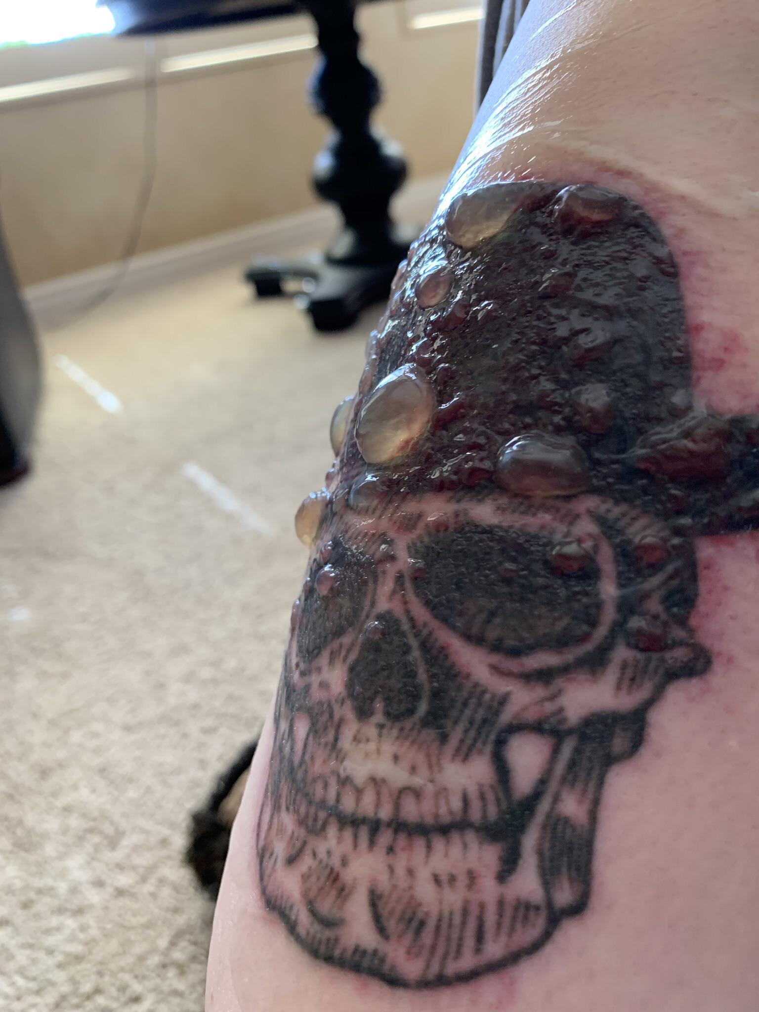 F o r b i d d e n p o p s. Post tattoo removal procedure