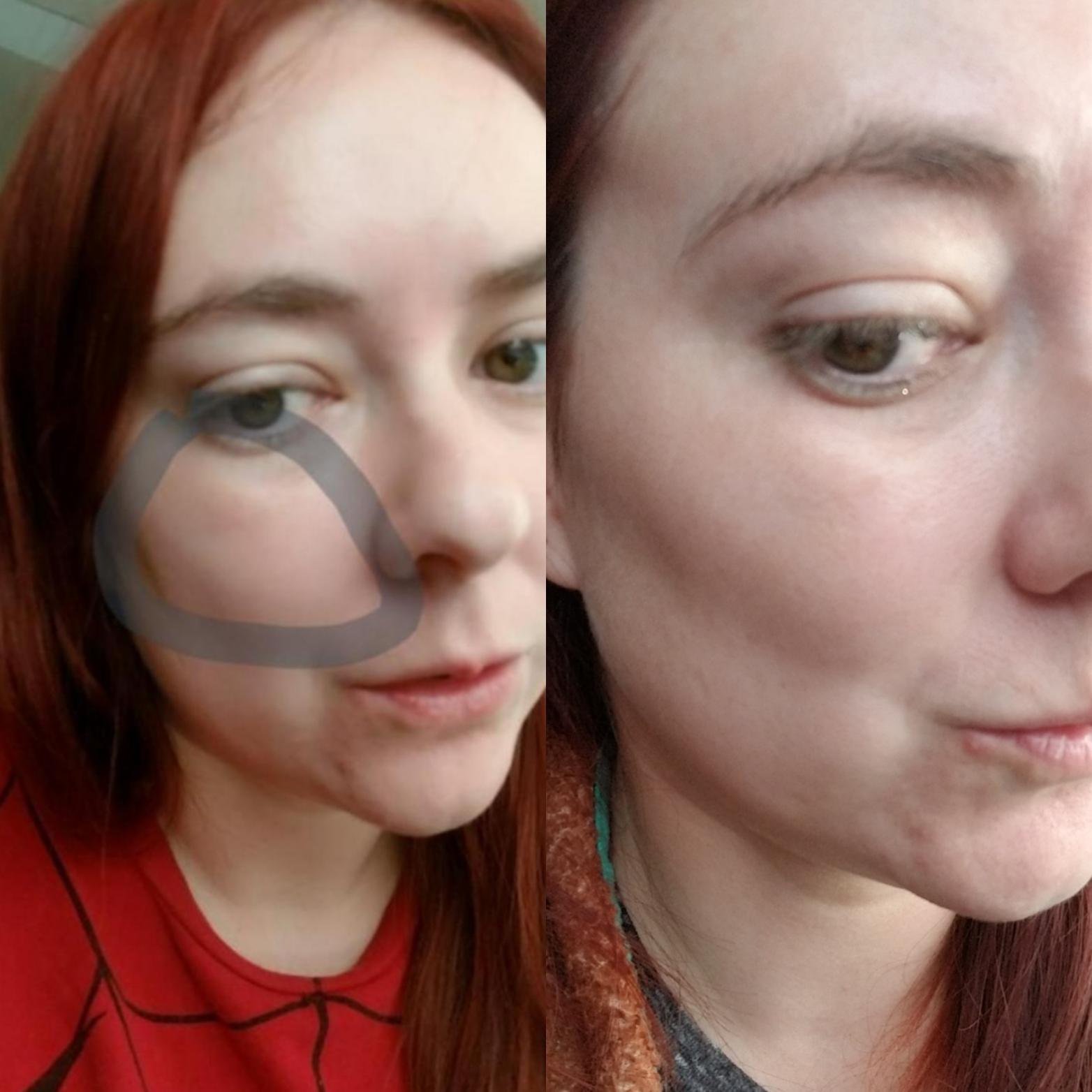 Cheek filler to hide the appearance of puffy undereyes/festoons. I know