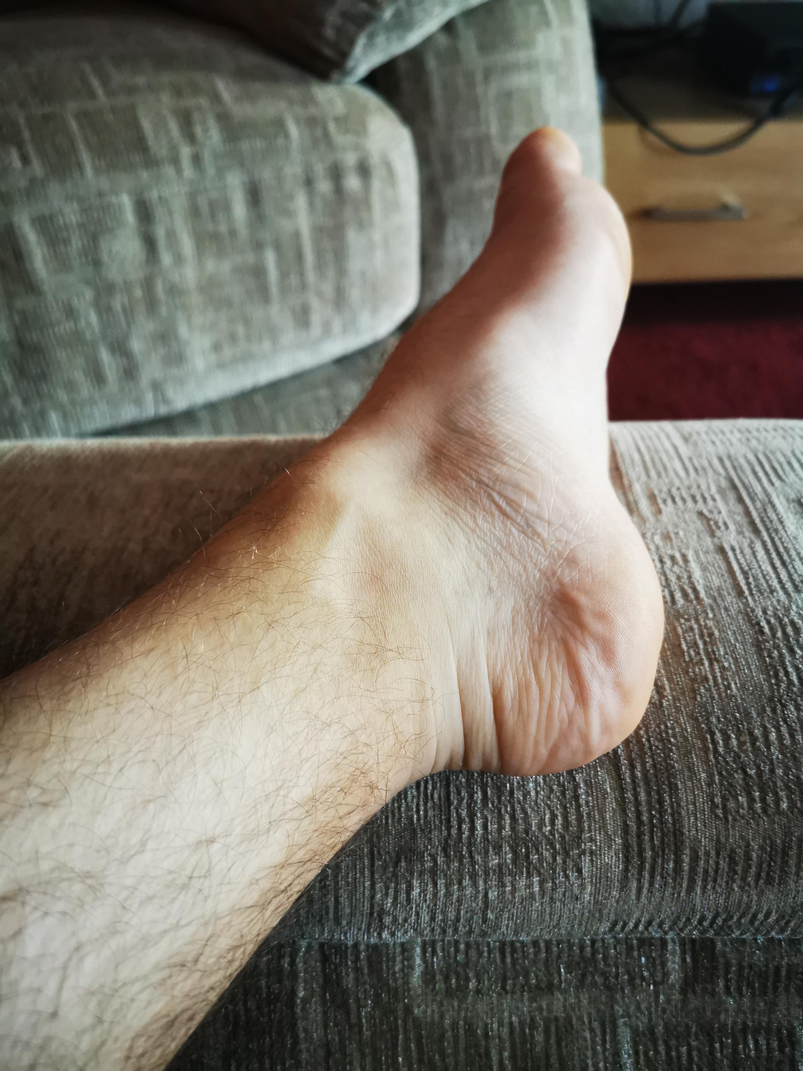 This is the natural resting position of both my ankles. I have both
