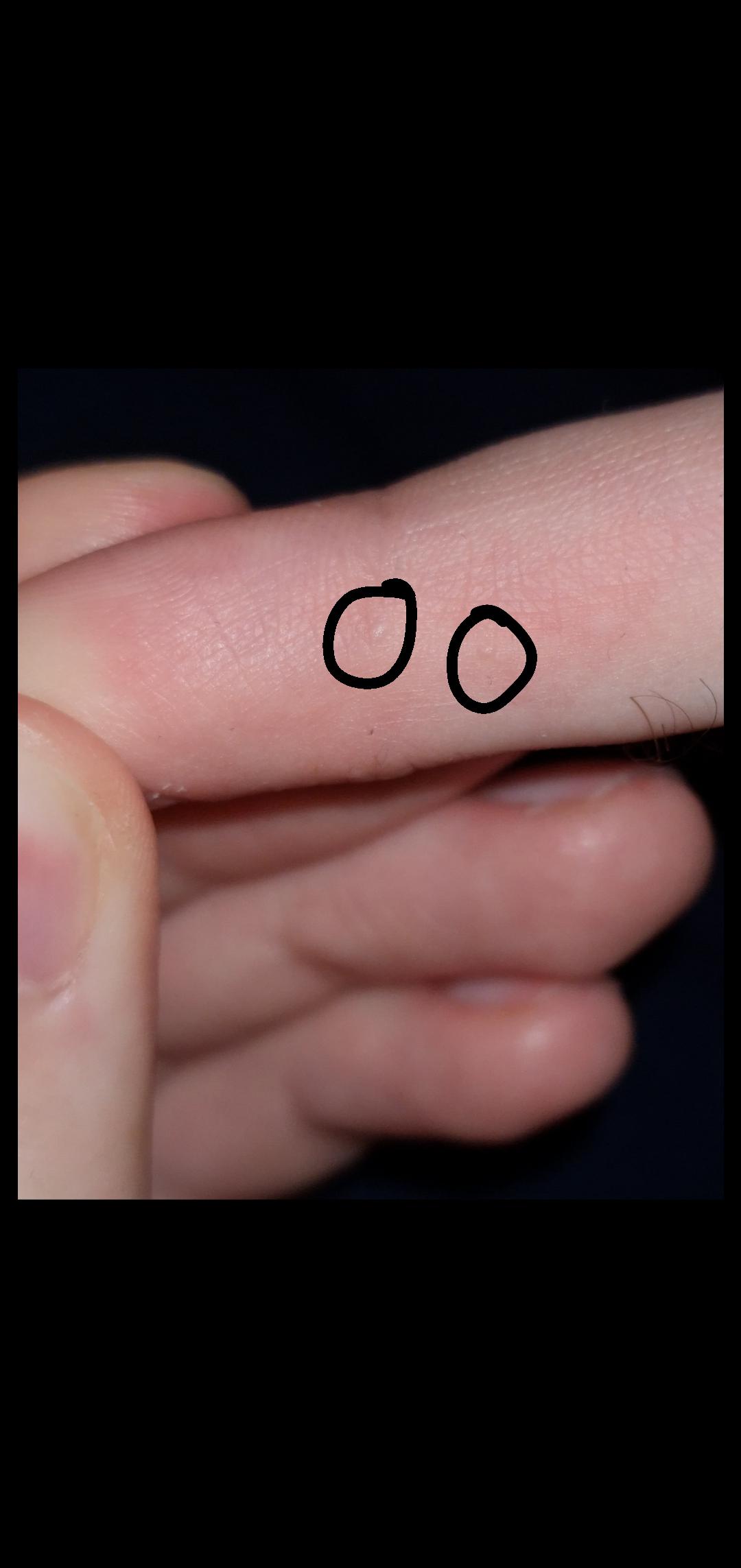 Months have passed. scabies