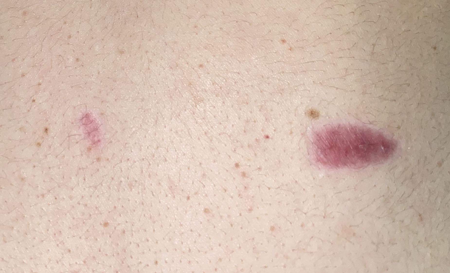 Burn scar r/DermatologyQuestions