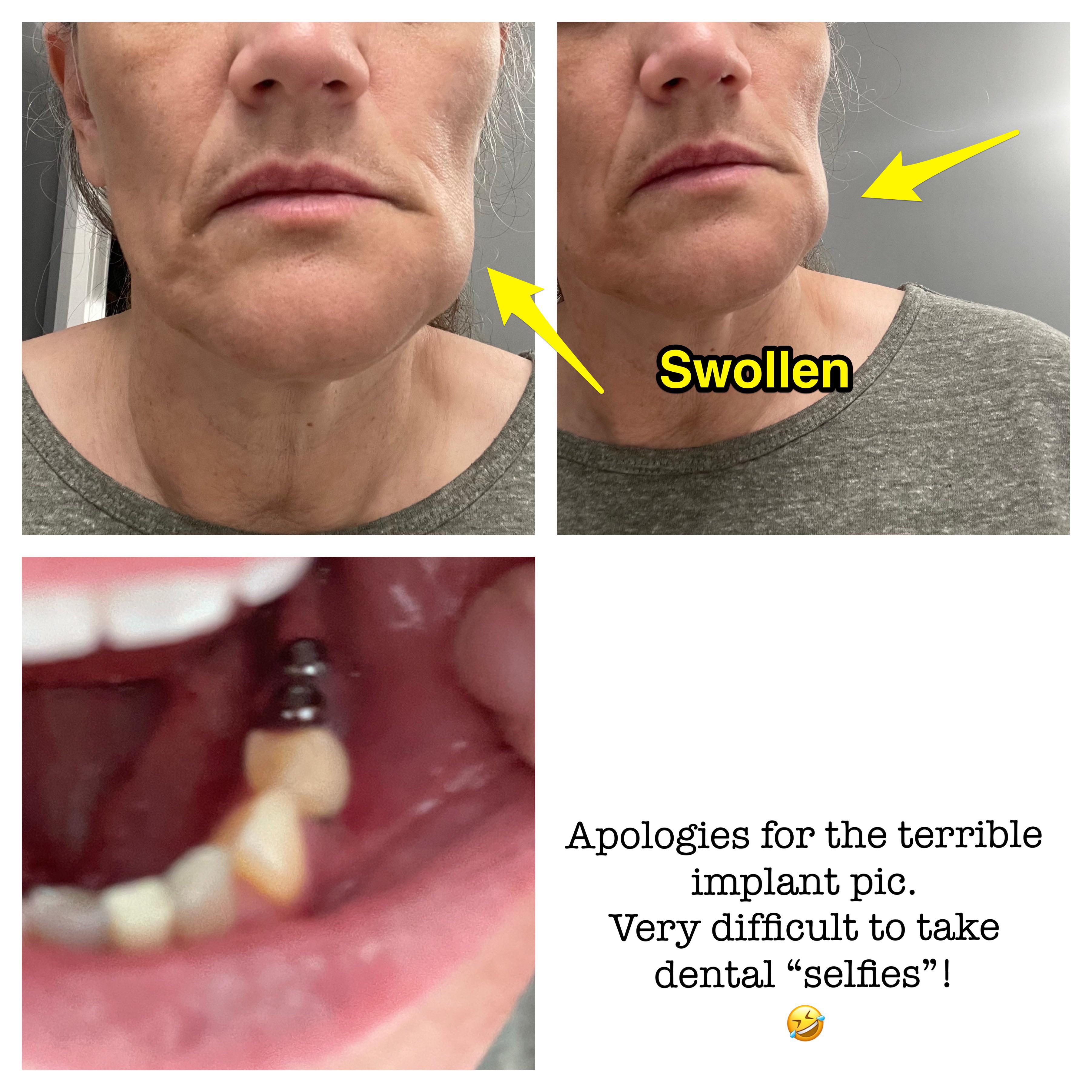 Almost 3 Weeks Post Implants Pain, Numbness and Swelling. See comment