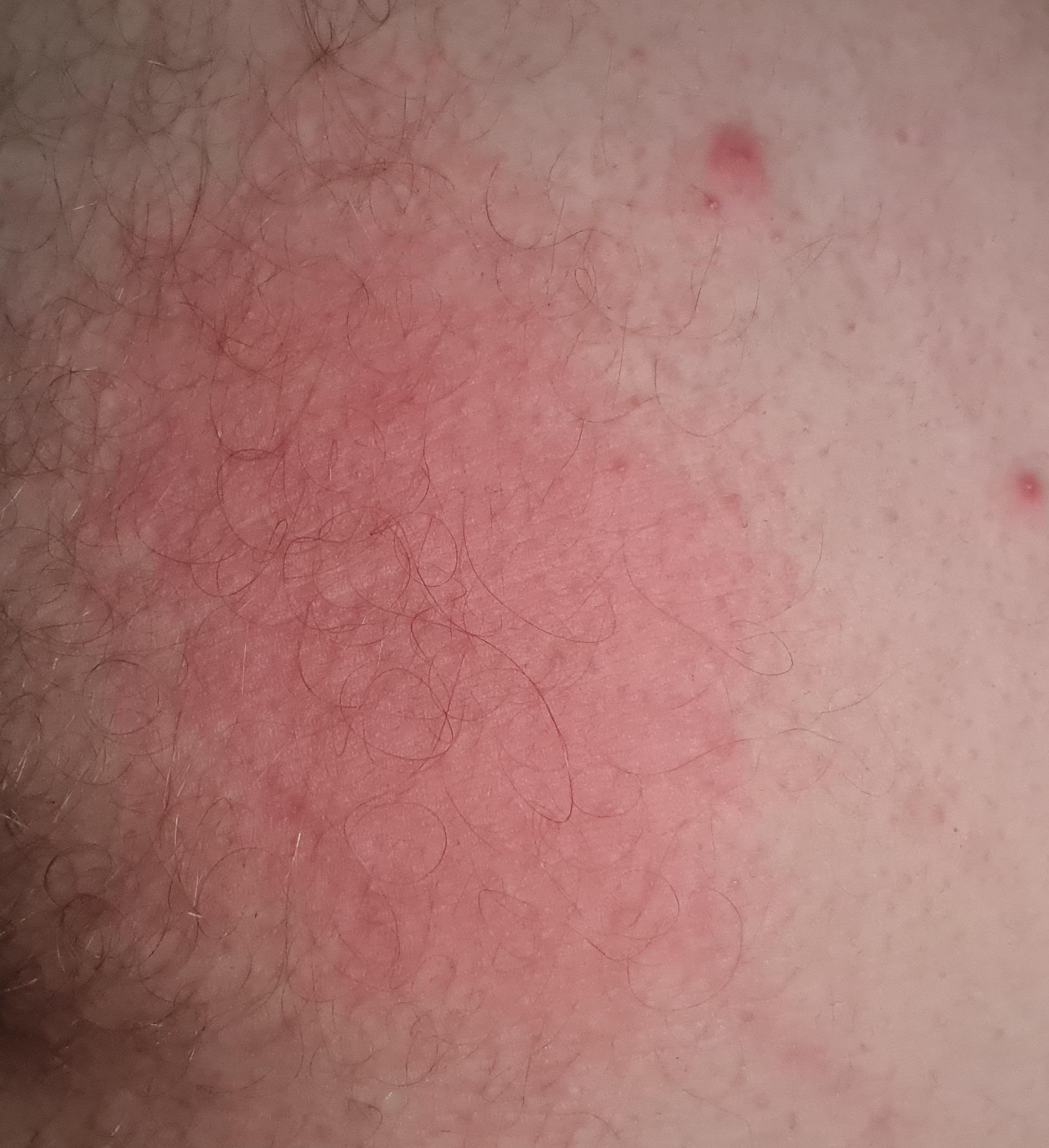 I appear to have developed a burning rash in the groin area. I can only