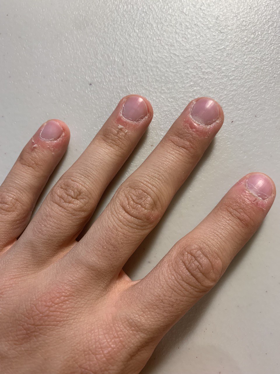 [Skin Concern] I've always had weak cuticles/skin peeling around my