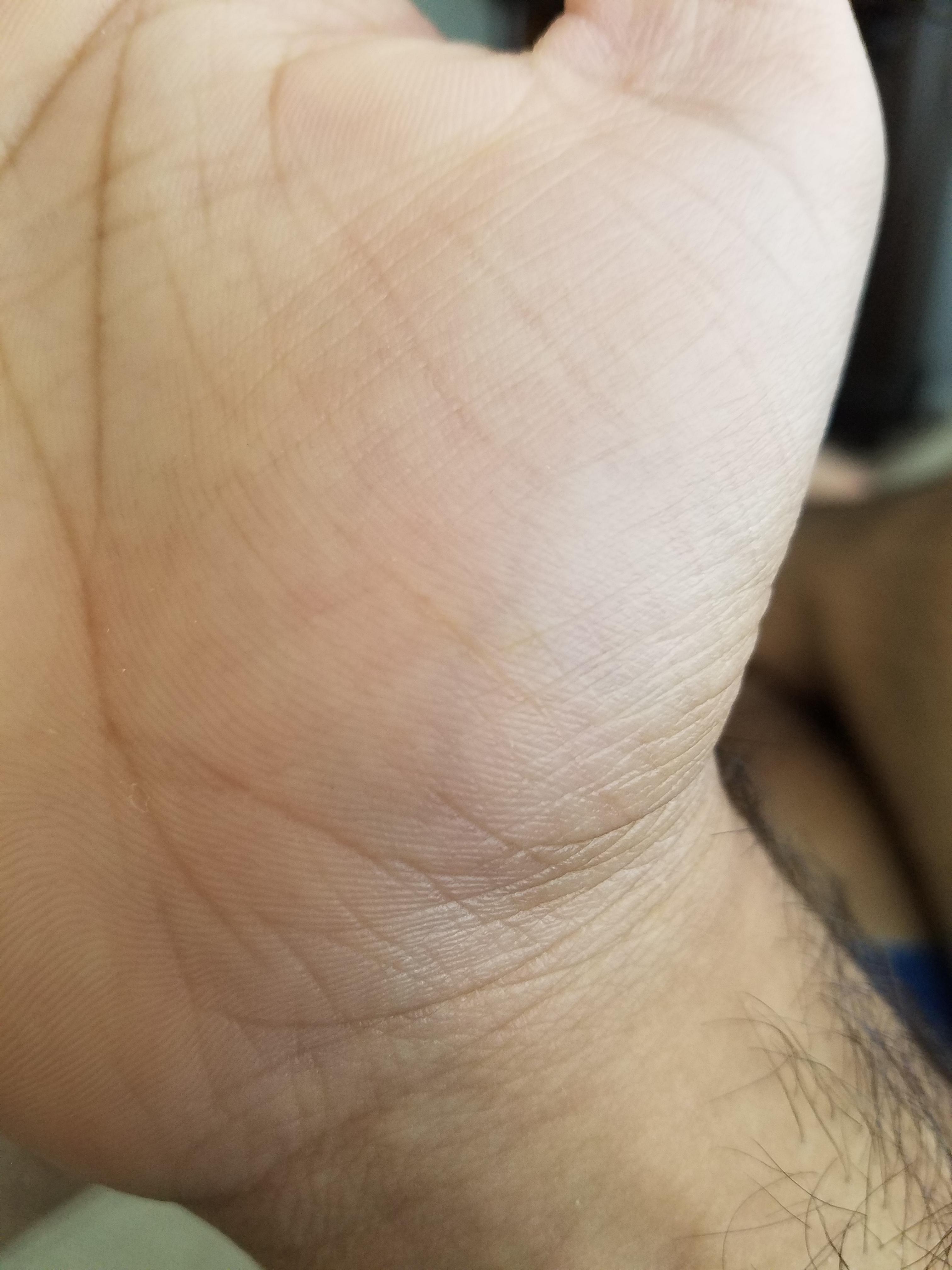 Small yellow spot on palm normal age 18 r/AskDoctorSmeeee