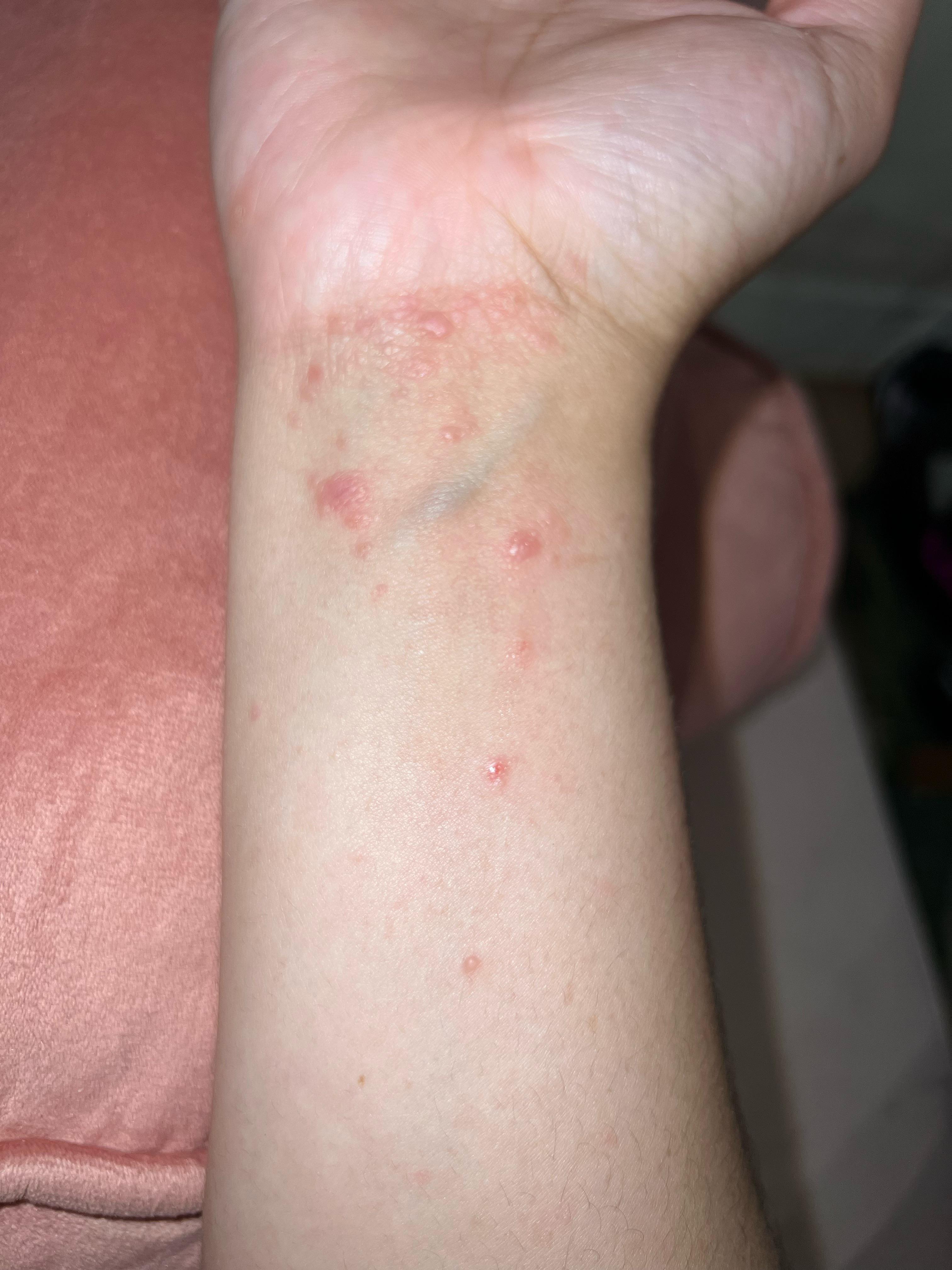 Forearm rash??? r/DermatologyQuestions