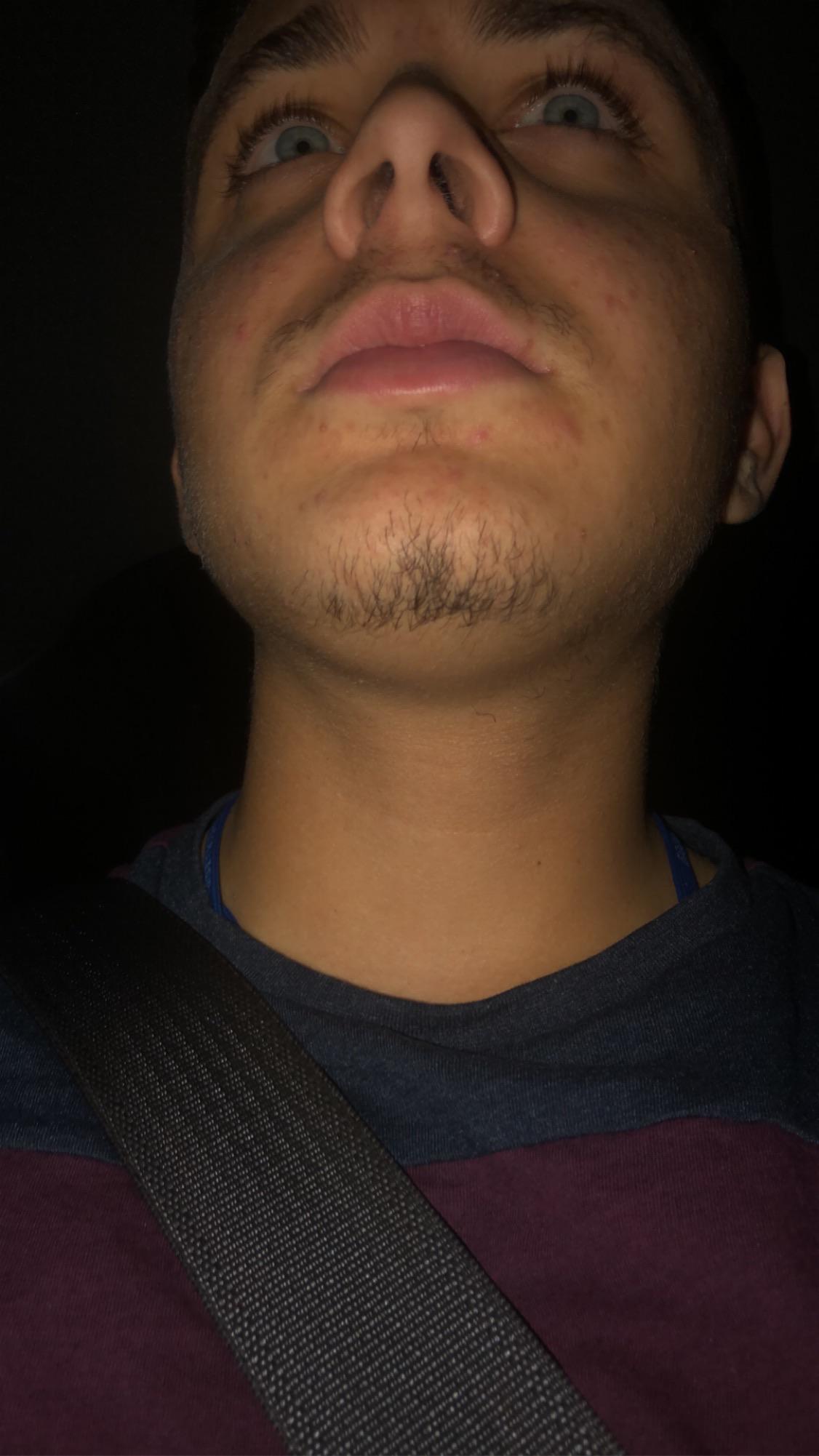 22 years old can only grow facial hair on chin and upper lip. 2 weeks